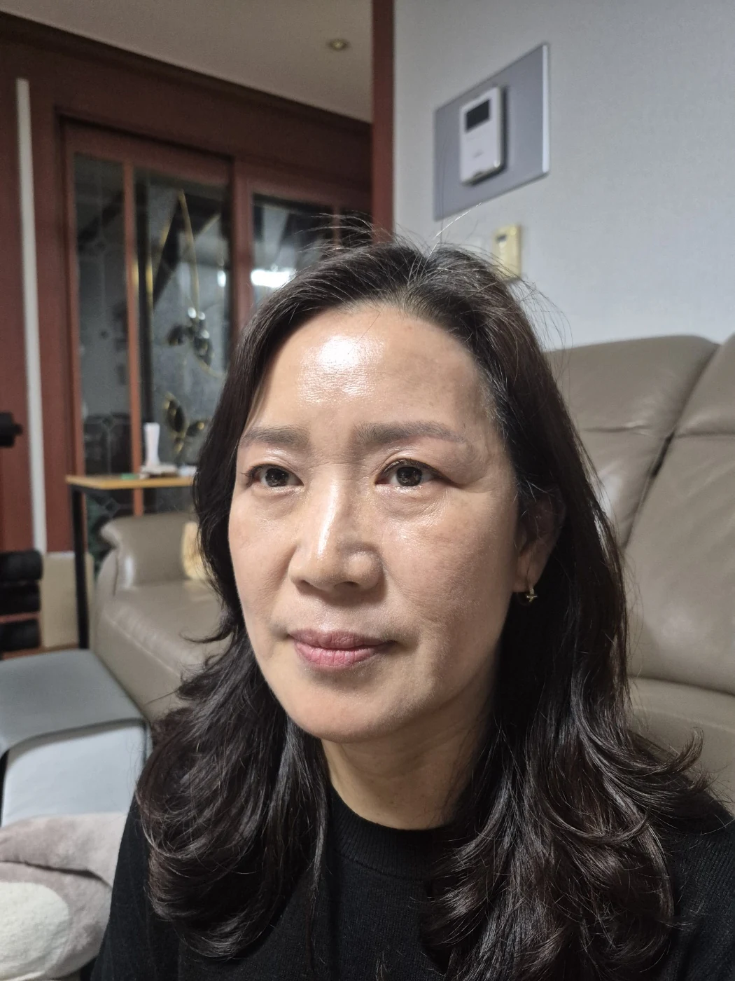 Sub-brow lift: recovery photographs through six months · Case 086 at Answer Plastic Surgery. Opposite oblique view — 2 months after surgery, sub-brow lift at Answer Plastic Surgery (case 086).