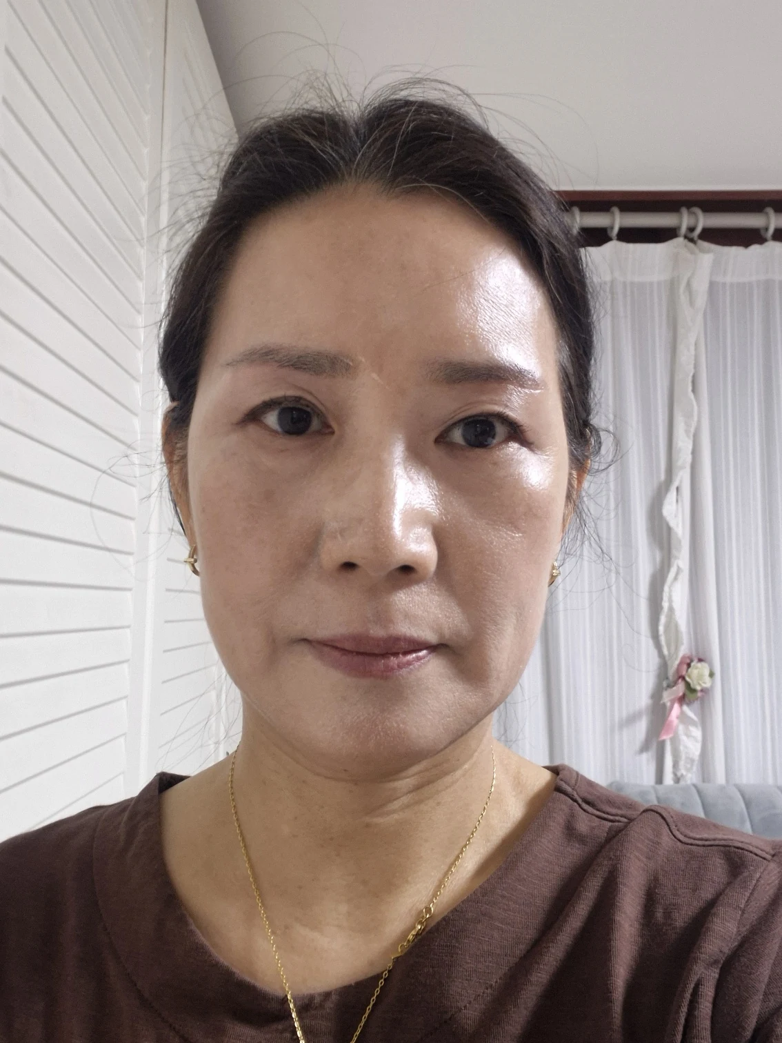 Sub-brow lift: recovery photographs through six months · Case 086 at Answer Plastic Surgery. Front view — 3 months after surgery, sub-brow lift at Answer Plastic Surgery (case 086).