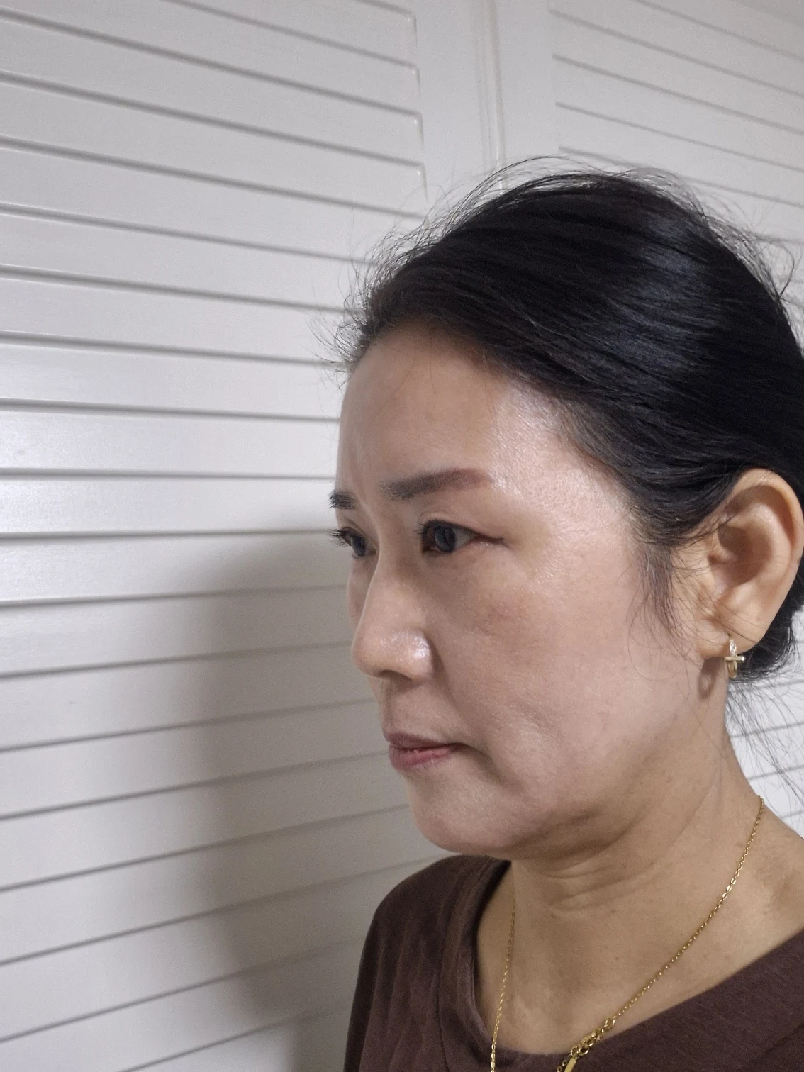 Sub-brow lift: recovery photographs through six months · Case 086 at Answer Plastic Surgery. Opposite oblique view — 3 months after surgery, sub-brow lift at Answer Plastic Surgery (case 086).