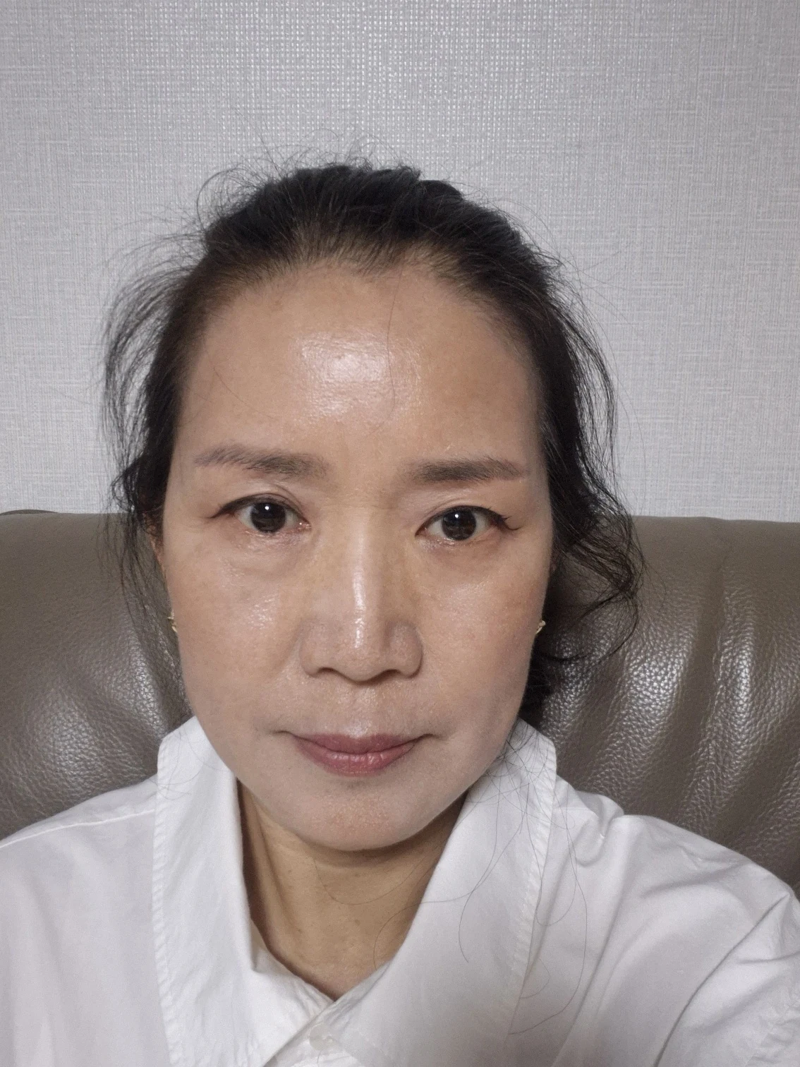 Sub-brow lift: recovery photographs through six months · Case 086 at Answer Plastic Surgery. Front view — 6 months after surgery, sub-brow lift at Answer Plastic Surgery (case 086).
