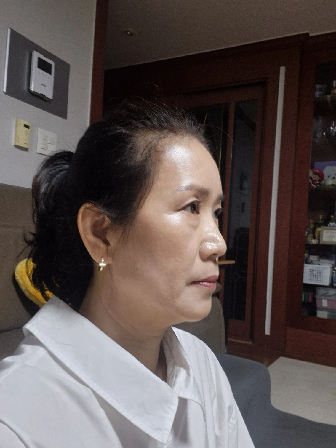 Sub-brow lift: recovery photographs through six months · Case 086 at Answer Plastic Surgery. Oblique view — 6 months after surgery, sub-brow lift at Answer Plastic Surgery (case 086).