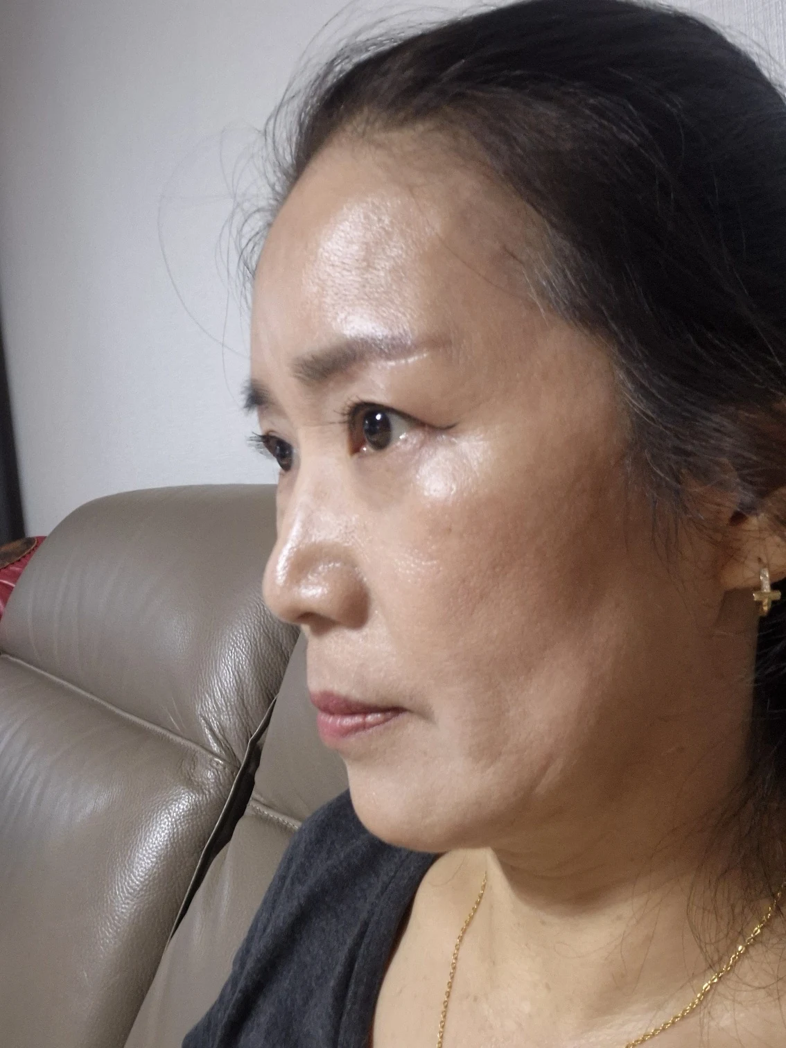 Sub-brow lift: recovery photographs through six months · Case 086 at Answer Plastic Surgery. Opposite oblique view — 6 months after surgery, sub-brow lift at Answer Plastic Surgery (case 086).