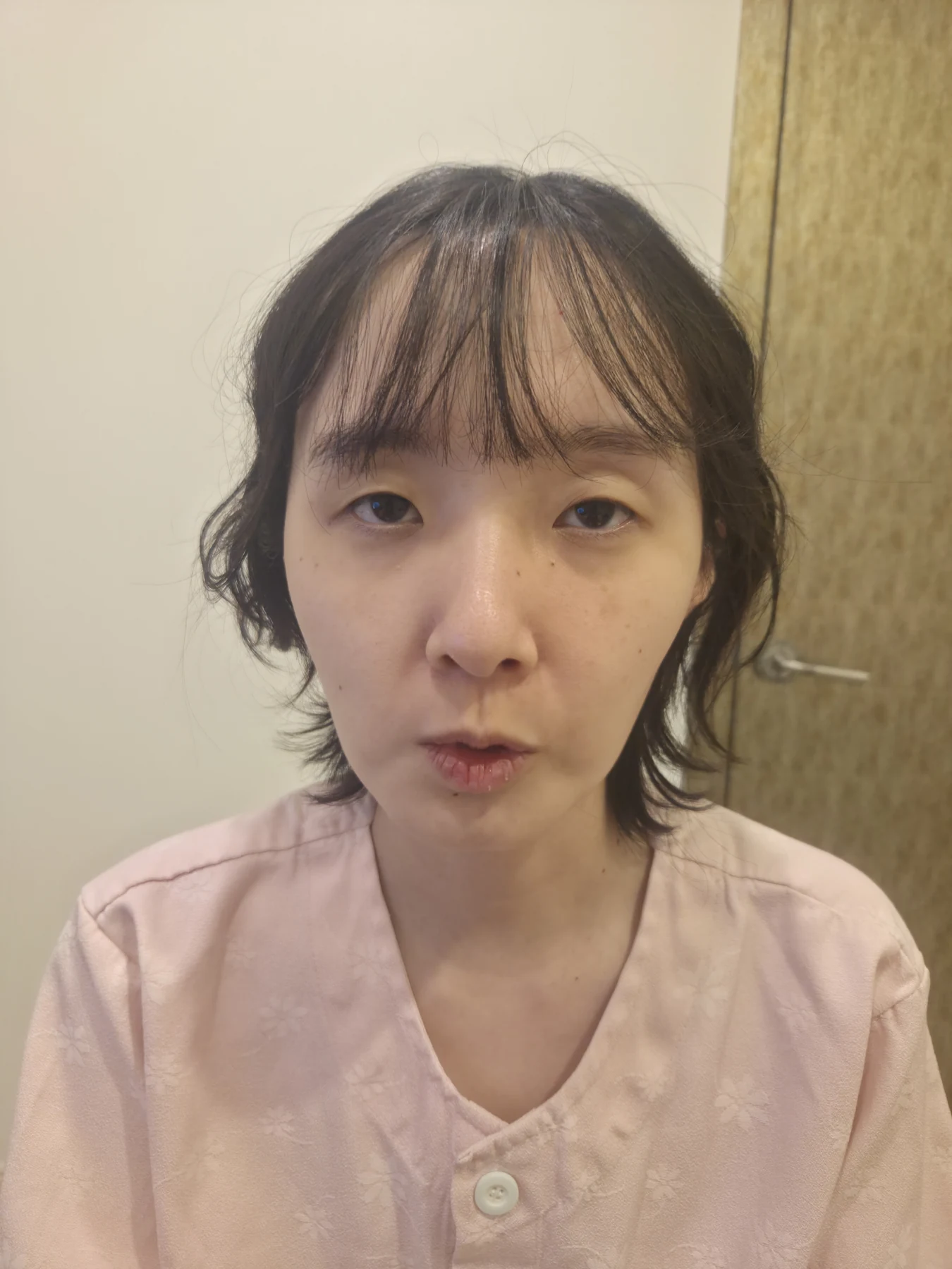 Eyelid surgery: three-month recovery and an asymmetry concern · Case 087 at Answer Plastic Surgery. Front view — before, eyelid surgery at Answer Plastic Surgery (case 087).