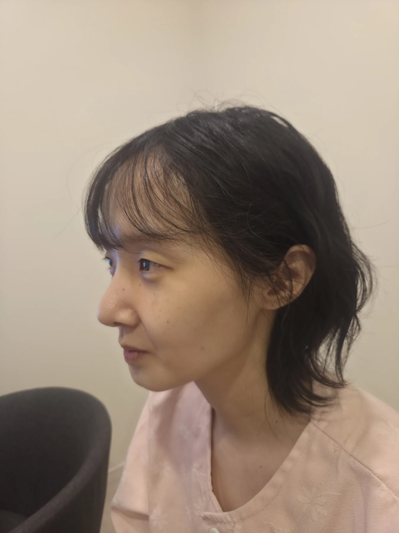 Eyelid surgery: three-month recovery and an asymmetry concern · Case 087 at Answer Plastic Surgery. Opposite oblique view — before, eyelid surgery at Answer Plastic Surgery (case 087).