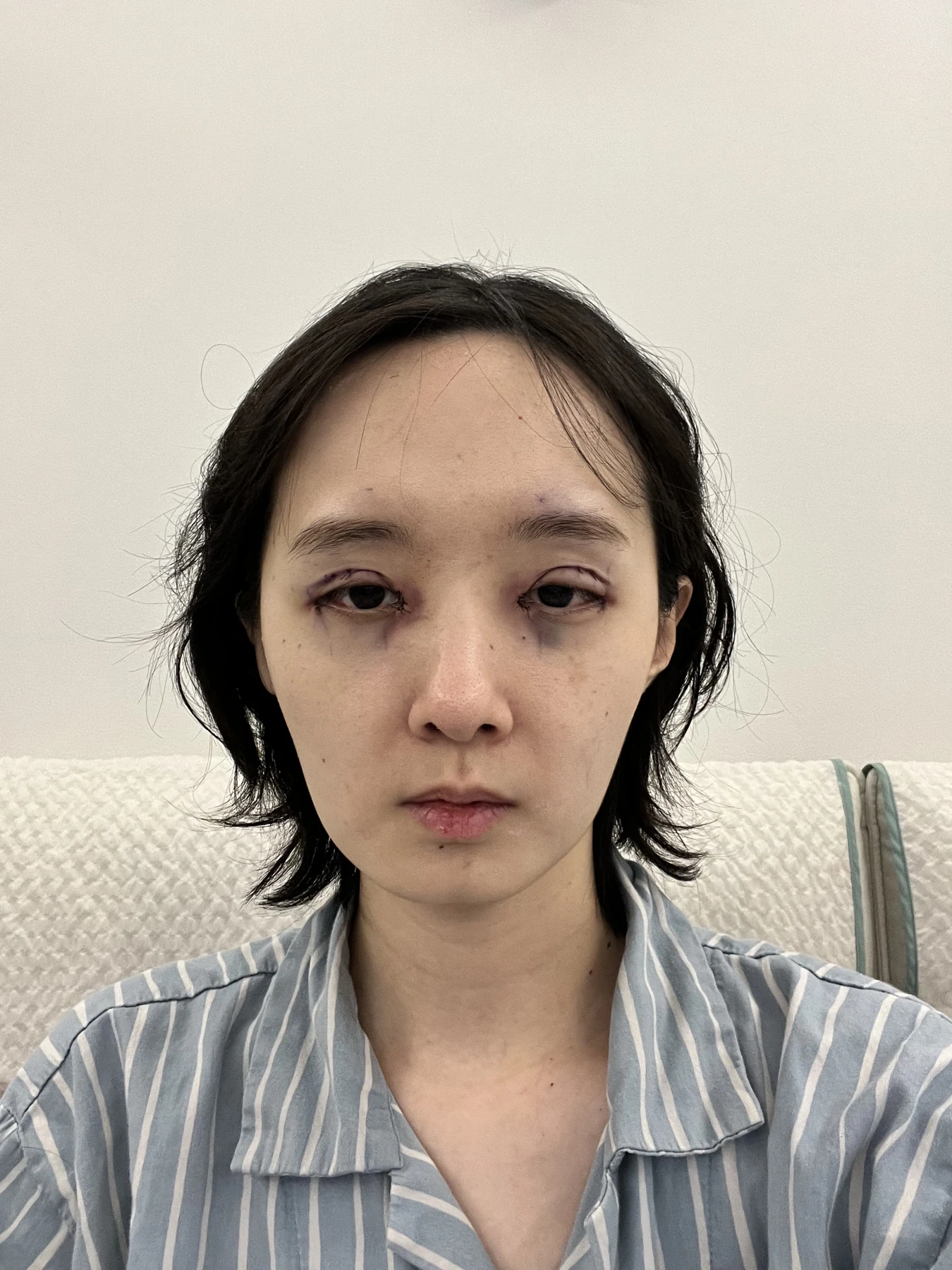 Eyelid surgery: three-month recovery and an asymmetry concern · Case 087 at Answer Plastic Surgery. Front view — surgery day, eyelid surgery at Answer Plastic Surgery (case 087).
