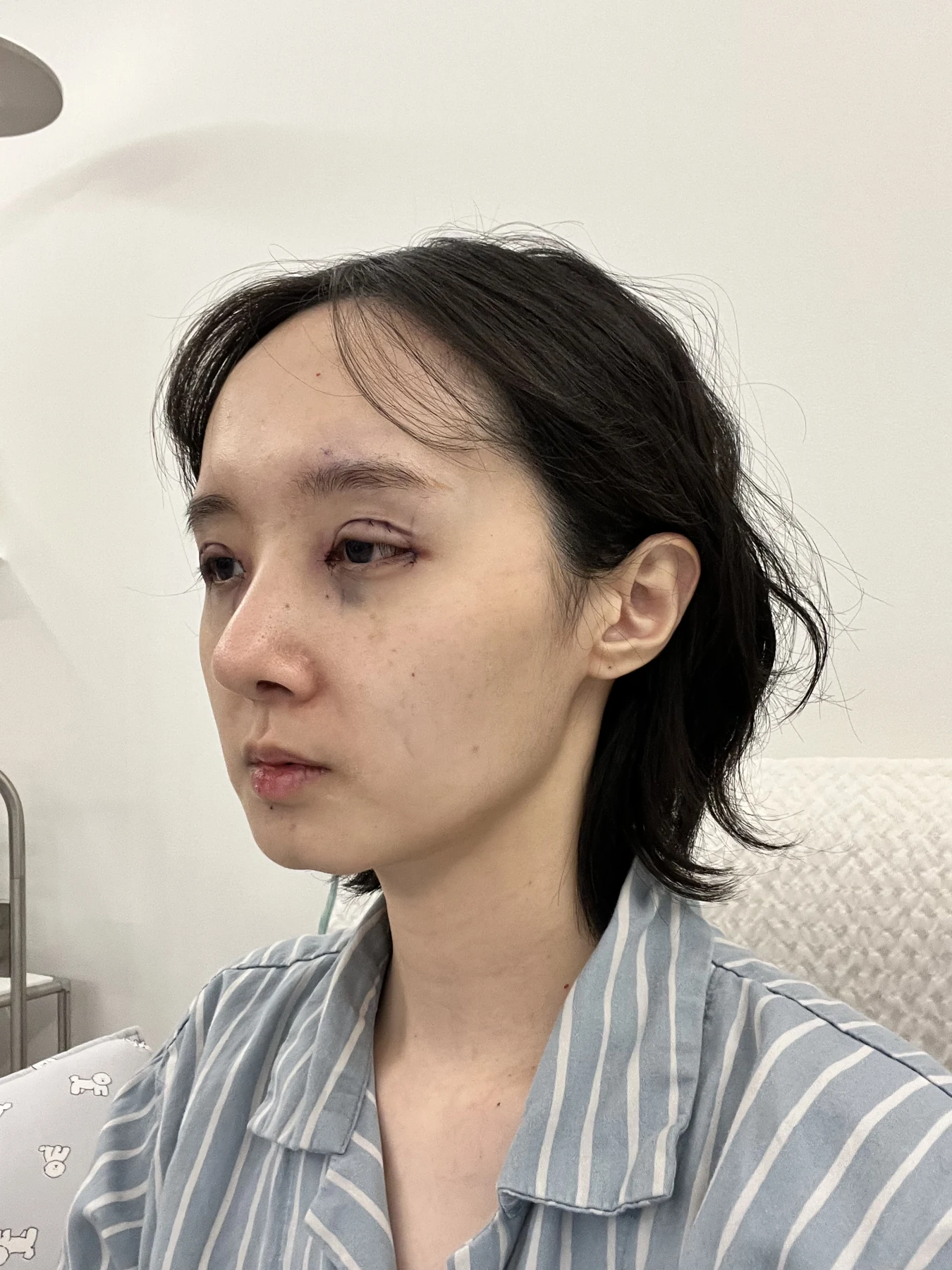 Eyelid surgery: three-month recovery and an asymmetry concern · Case 087 at Answer Plastic Surgery. Oblique view — surgery day, eyelid surgery at Answer Plastic Surgery (case 087).