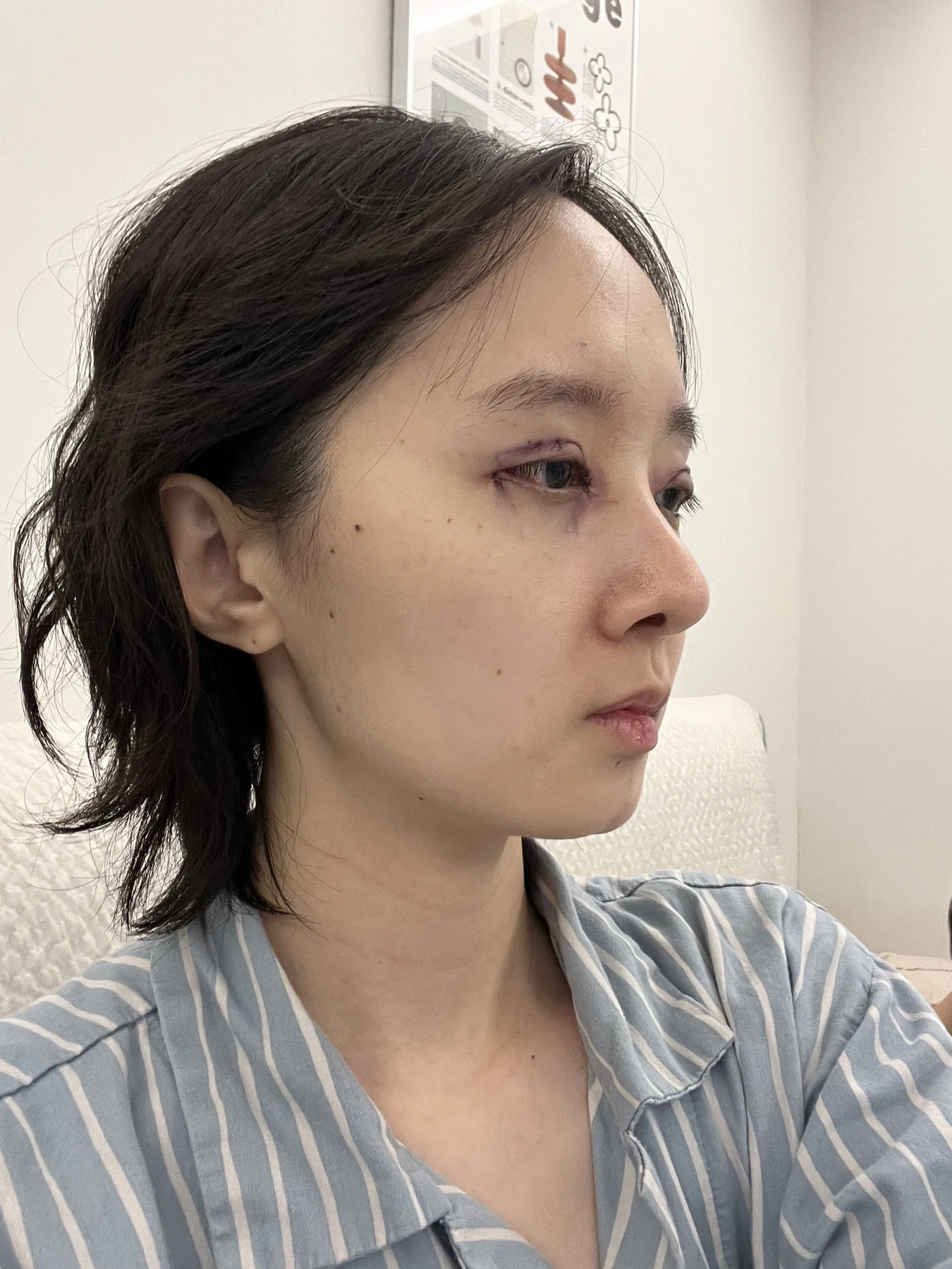 Eyelid surgery: three-month recovery and an asymmetry concern · Case 087 at Answer Plastic Surgery. Opposite oblique view — surgery day, eyelid surgery at Answer Plastic Surgery (case 087).