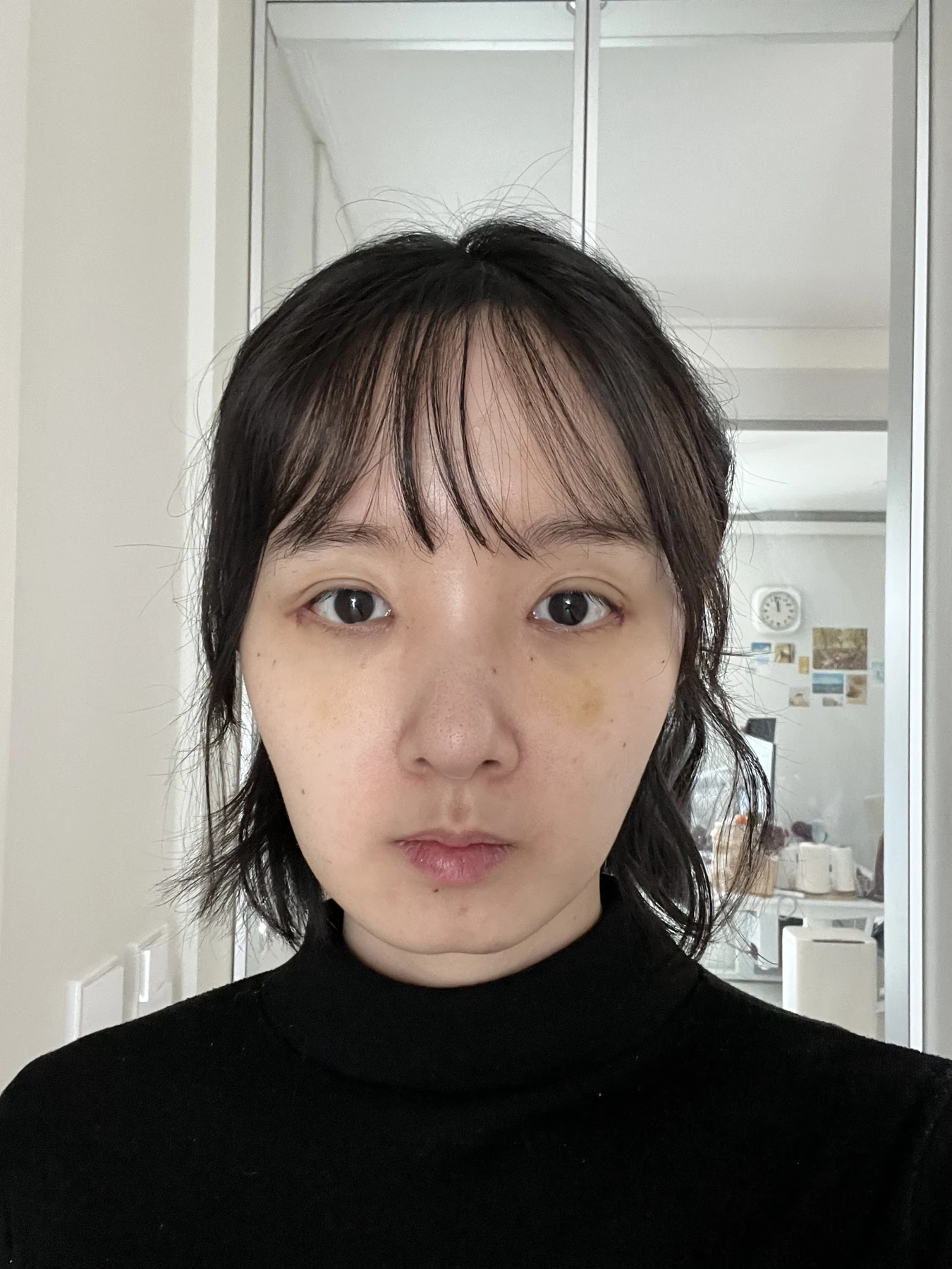 Eyelid surgery: three-month recovery and an asymmetry concern · Case 087 at Answer Plastic Surgery. Front view — 1 week after surgery, eyelid surgery at Answer Plastic Surgery (case 087).