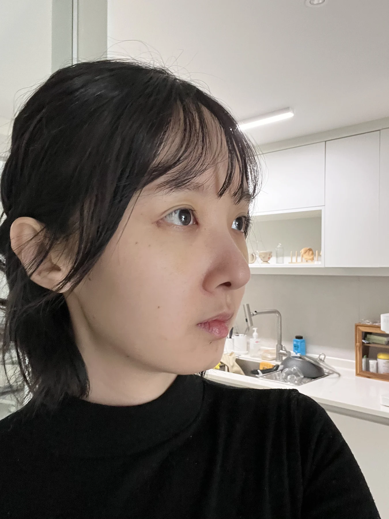 Eyelid surgery: three-month recovery and an asymmetry concern · Case 087 at Answer Plastic Surgery. Oblique view — 1 week after surgery, eyelid surgery at Answer Plastic Surgery (case 087).