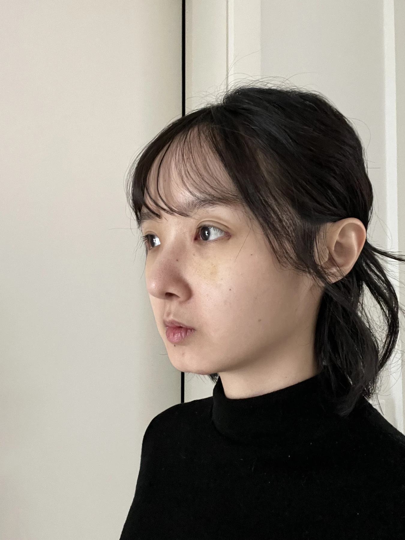 Eyelid surgery: three-month recovery and an asymmetry concern · Case 087 at Answer Plastic Surgery. Opposite oblique view — 1 week after surgery, eyelid surgery at Answer Plastic Surgery (case 087).