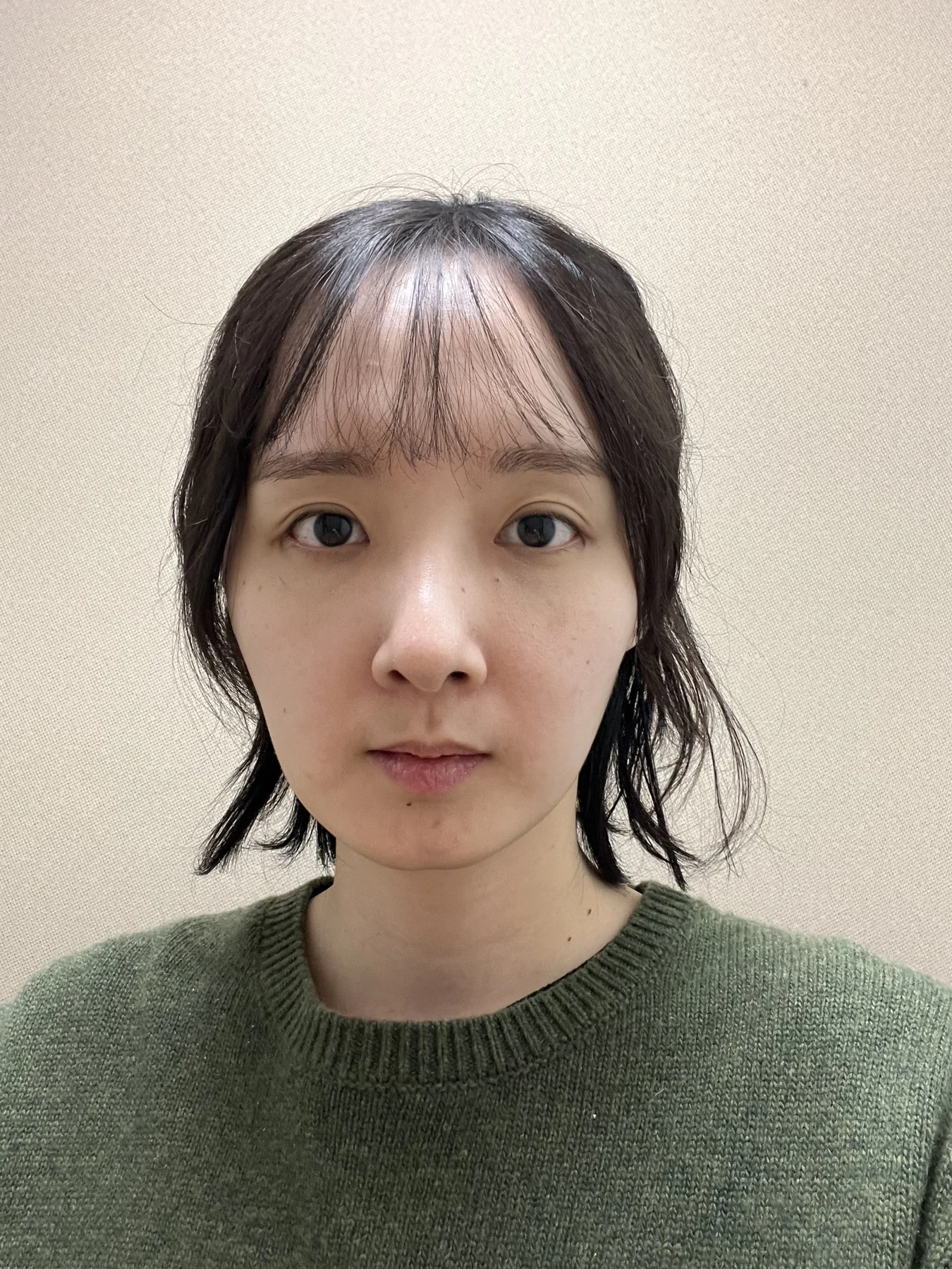 Eyelid surgery: three-month recovery and an asymmetry concern · Case 087 at Answer Plastic Surgery. Front view — 2 weeks after surgery, eyelid surgery at Answer Plastic Surgery (case 087).