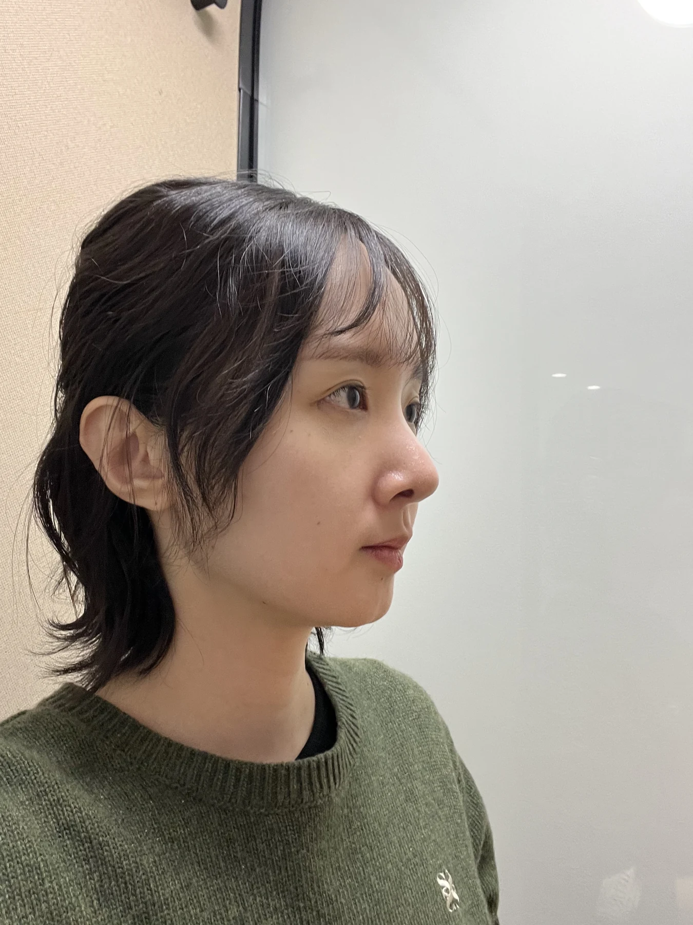 Eyelid surgery: three-month recovery and an asymmetry concern · Case 087 at Answer Plastic Surgery. Oblique view — 2 weeks after surgery, eyelid surgery at Answer Plastic Surgery (case 087).