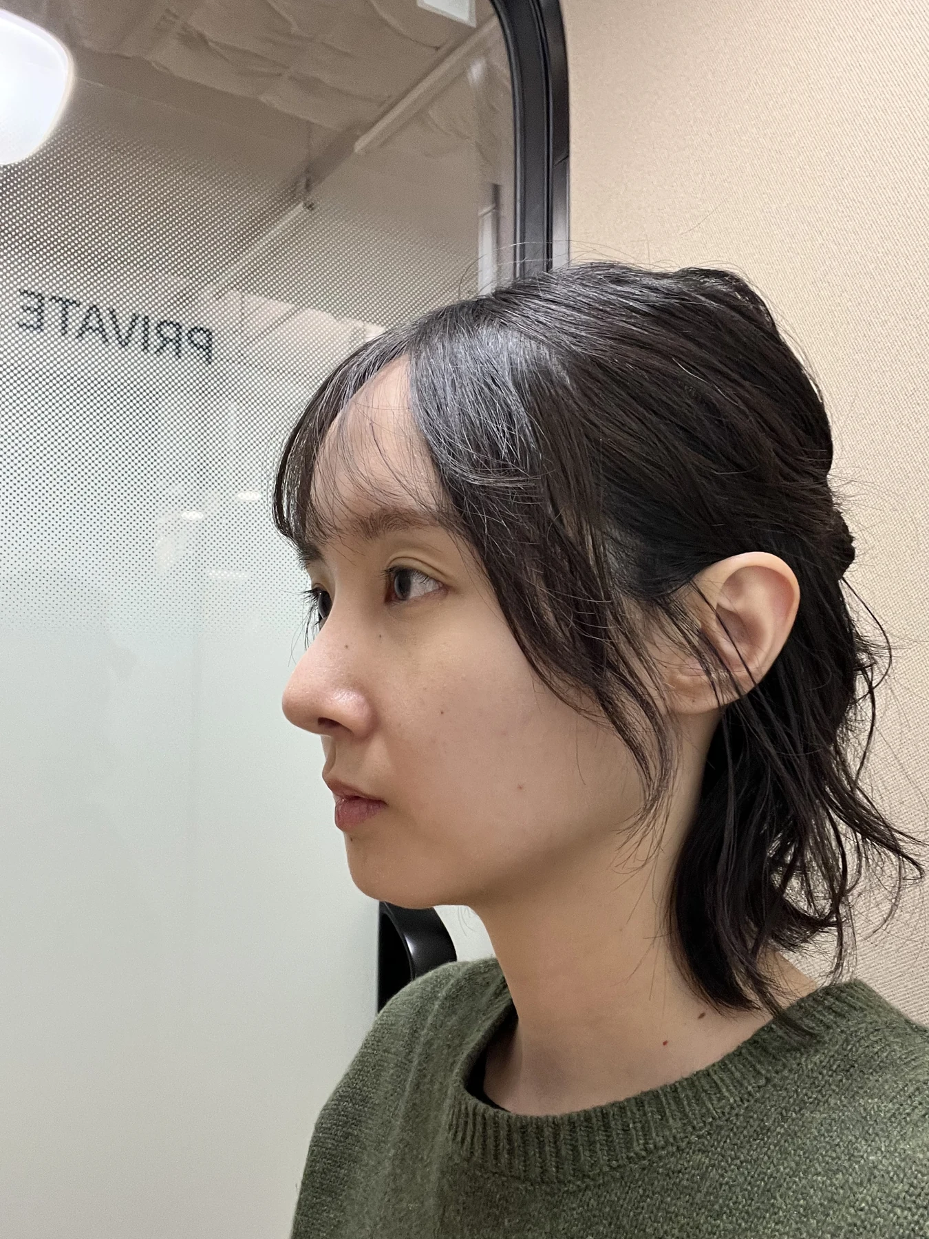 Eyelid surgery: three-month recovery and an asymmetry concern · Case 087 at Answer Plastic Surgery. Opposite oblique view — 2 weeks after surgery, eyelid surgery at Answer Plastic Surgery (case 087).