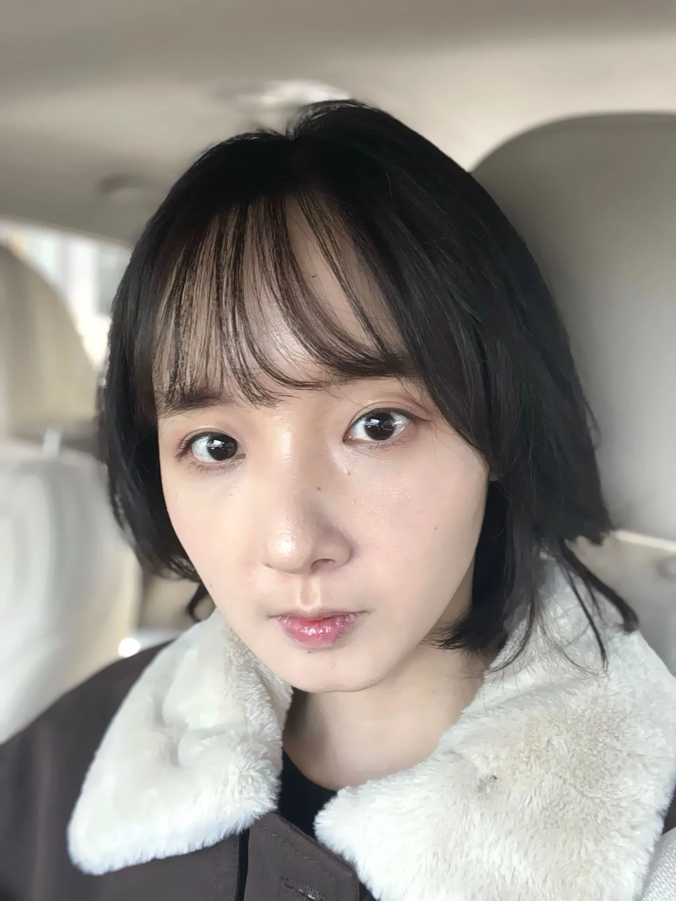 Eyelid surgery: three-month recovery and an asymmetry concern · Case 087 at Answer Plastic Surgery. Front view — 1 month after surgery, eyelid surgery at Answer Plastic Surgery (case 087).