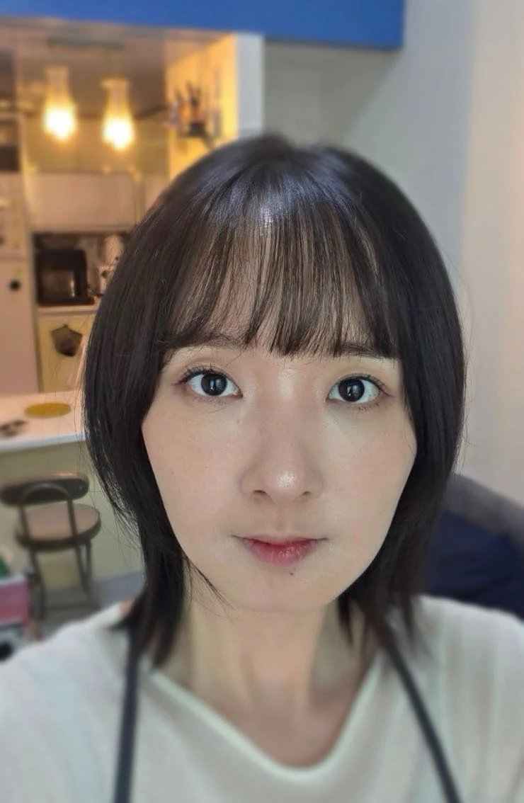 Eyelid surgery: three-month recovery and an asymmetry concern · Case 087 at Answer Plastic Surgery. Front view — 2 months after surgery, eyelid surgery at Answer Plastic Surgery (case 087).