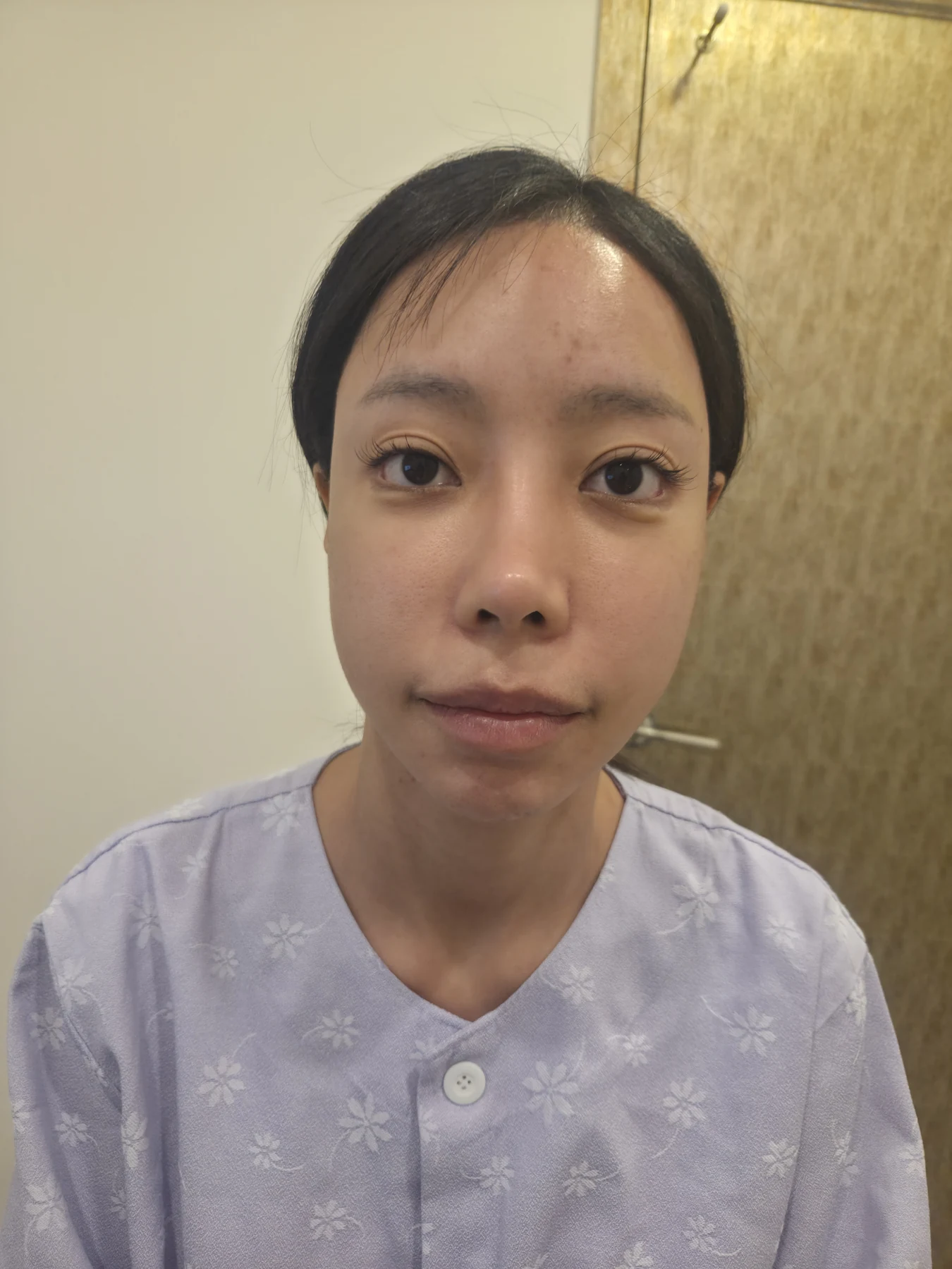 Outer eye-corner revision after previous canthoplasty: six months · Case 088 at Answer Plastic Surgery. Front view — before, outer eye-corner revision after previous canthoplasty at Answer Plastic Surgery (case 088).