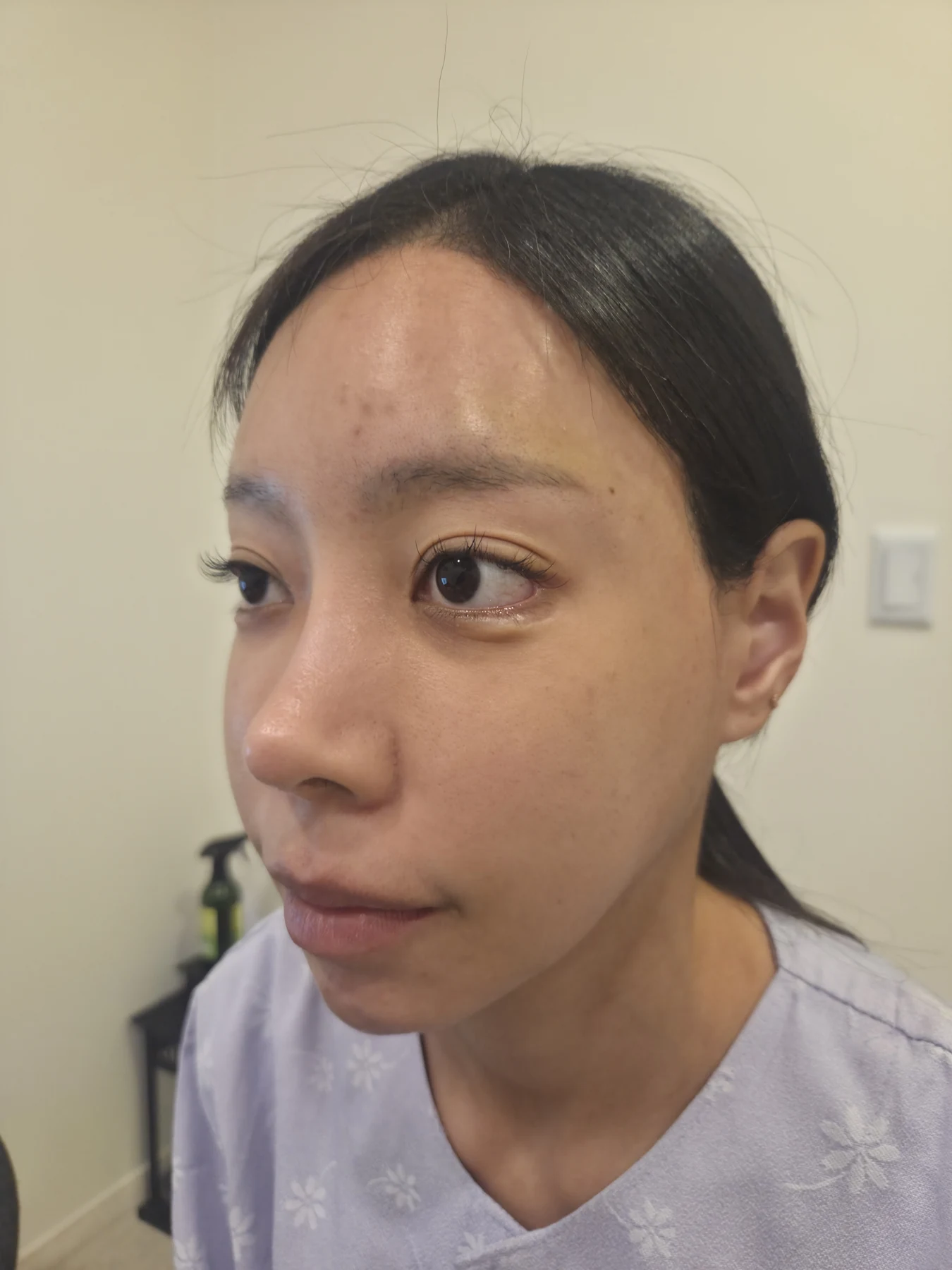 Outer eye-corner revision after previous canthoplasty: six months · Case 088 at Answer Plastic Surgery. Oblique view — before, outer eye-corner revision after previous canthoplasty at Answer Plastic Surgery (case 088).