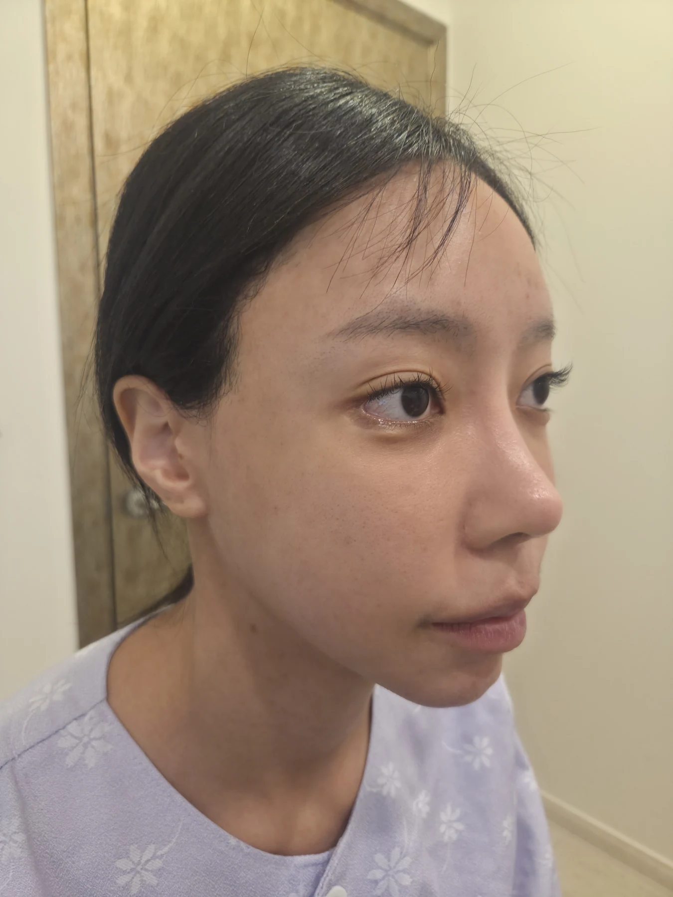 Outer eye-corner revision after previous canthoplasty: six months · Case 088 at Answer Plastic Surgery. Opposite oblique view — before, outer eye-corner revision after previous canthoplasty at Answer Plastic Surgery (case 088).