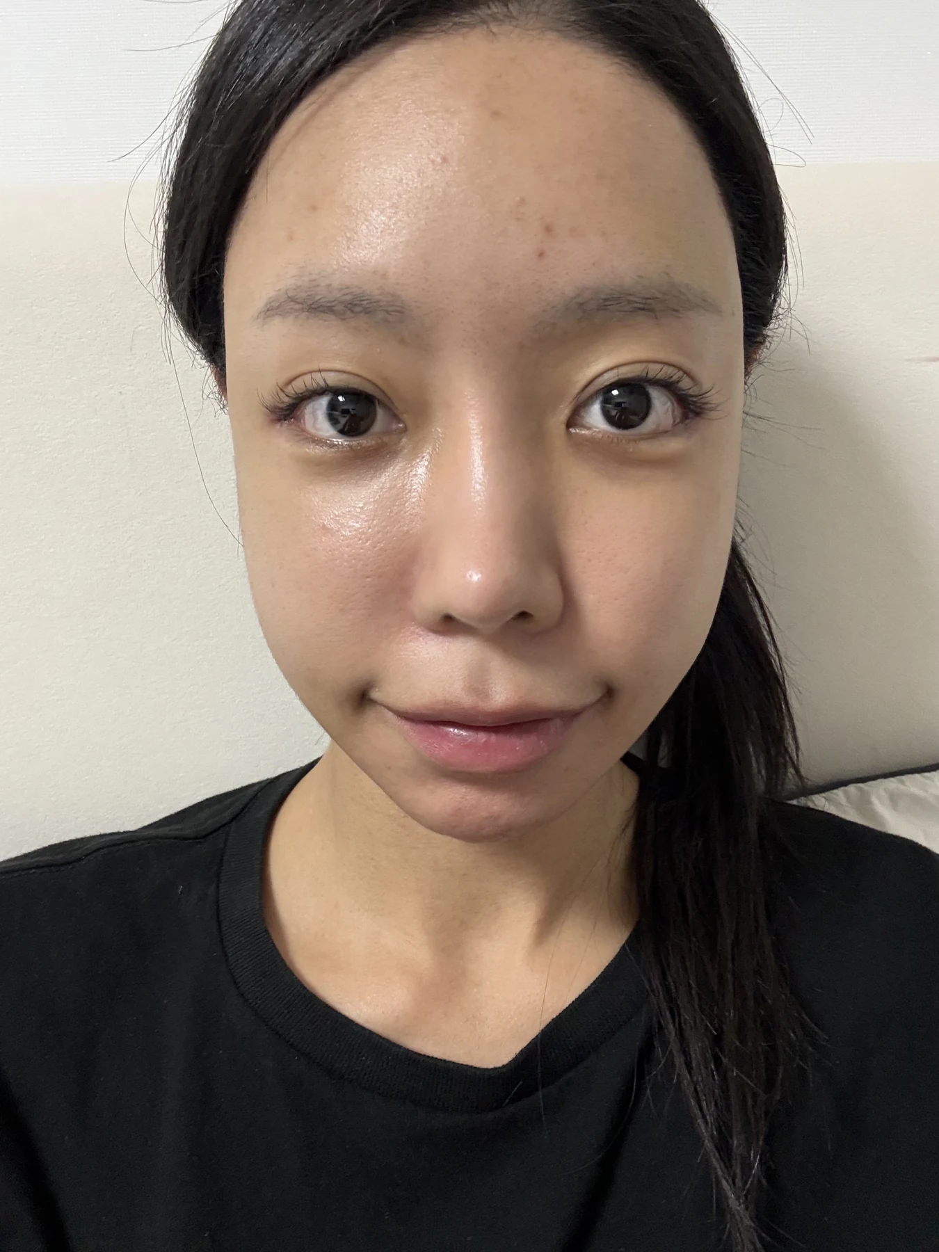 Outer eye-corner revision after previous canthoplasty: six months · Case 088 at Answer Plastic Surgery. Front view — surgery day, outer eye-corner revision after previous canthoplasty at Answer Plastic Surgery (case 088).