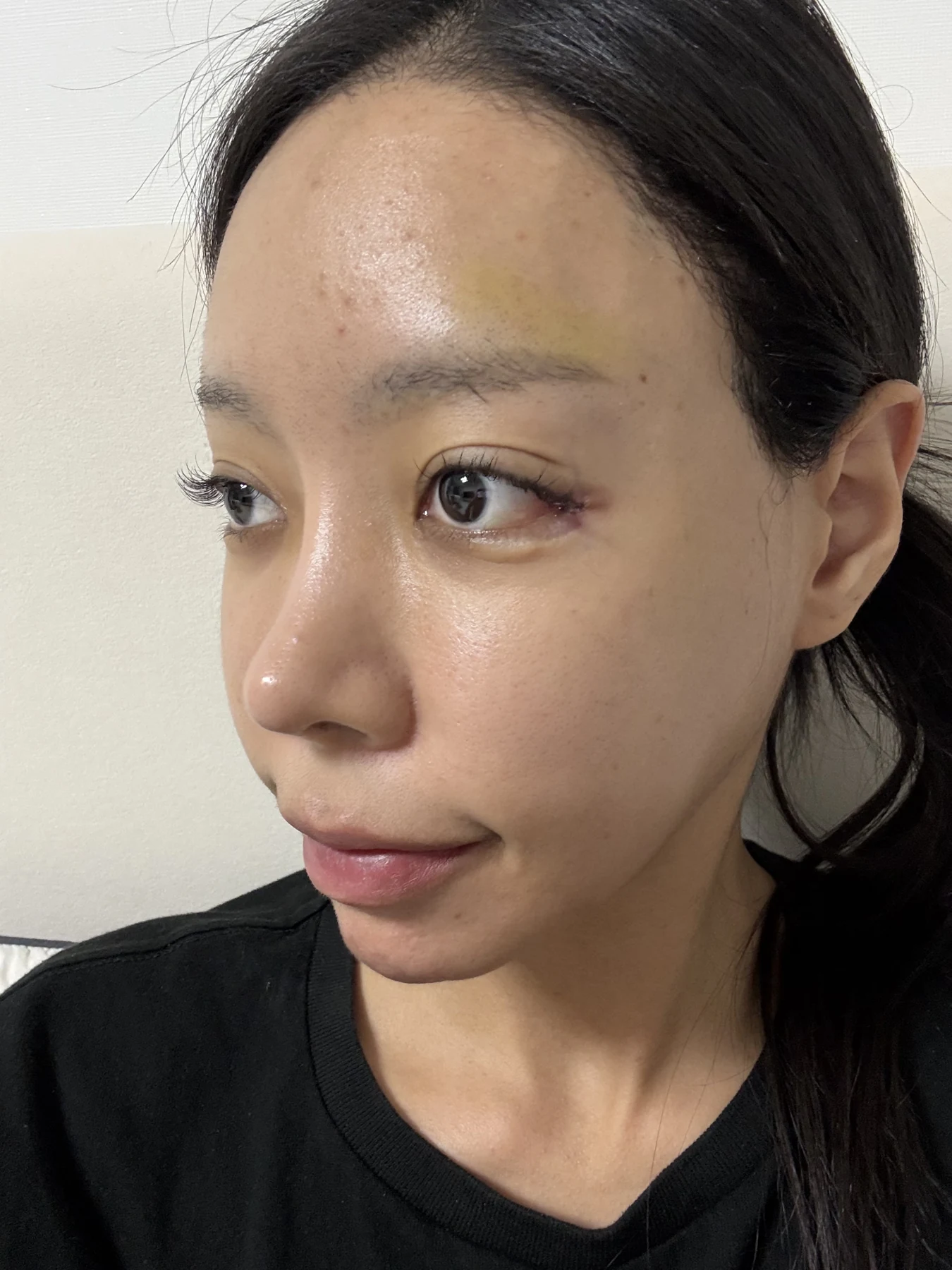 Outer eye-corner revision after previous canthoplasty: six months · Case 088 at Answer Plastic Surgery. Oblique view — surgery day, outer eye-corner revision after previous canthoplasty at Answer Plastic Surgery (case 088).