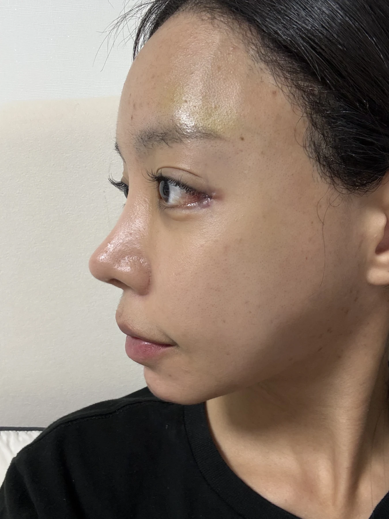 Outer eye-corner revision after previous canthoplasty: six months · Case 088 at Answer Plastic Surgery. Side view — surgery day, outer eye-corner revision after previous canthoplasty at Answer Plastic Surgery (case 088).