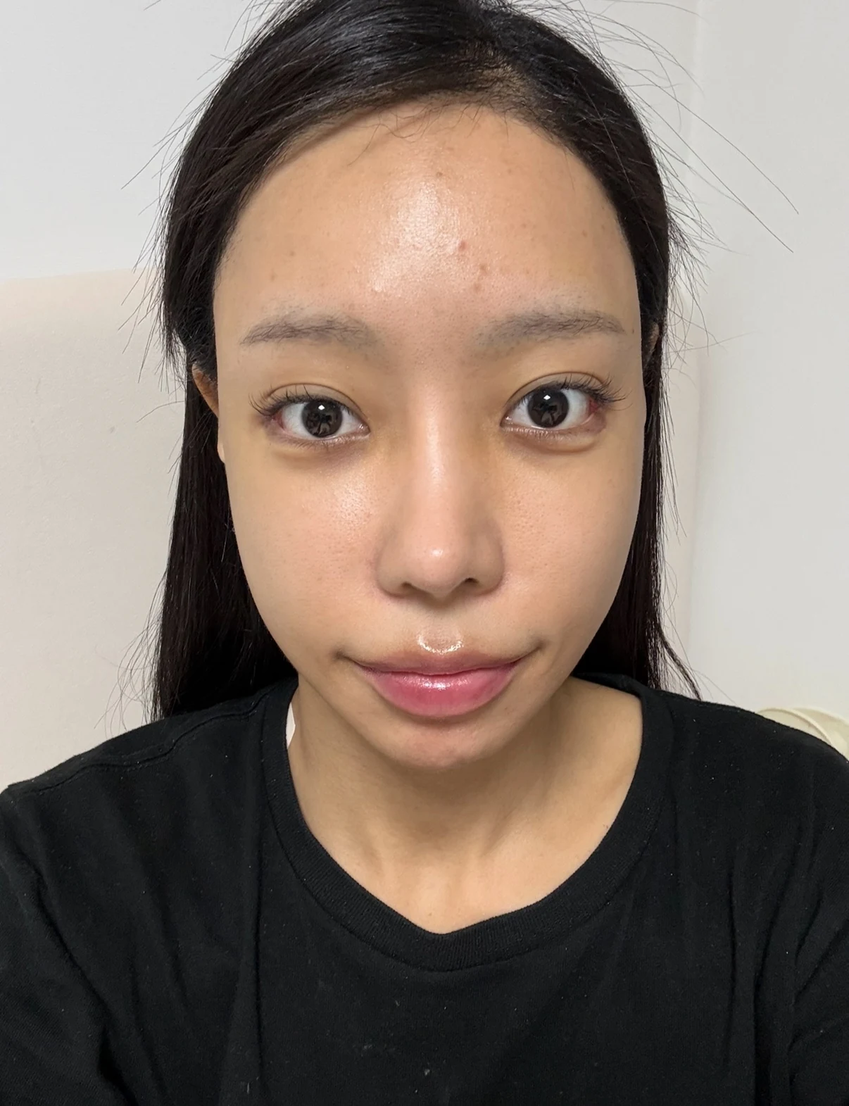 Outer eye-corner revision after previous canthoplasty: six months · Case 088 at Answer Plastic Surgery. Front view — 1 week after surgery, outer eye-corner revision after previous canthoplasty at Answer Plastic Surgery (case 088).