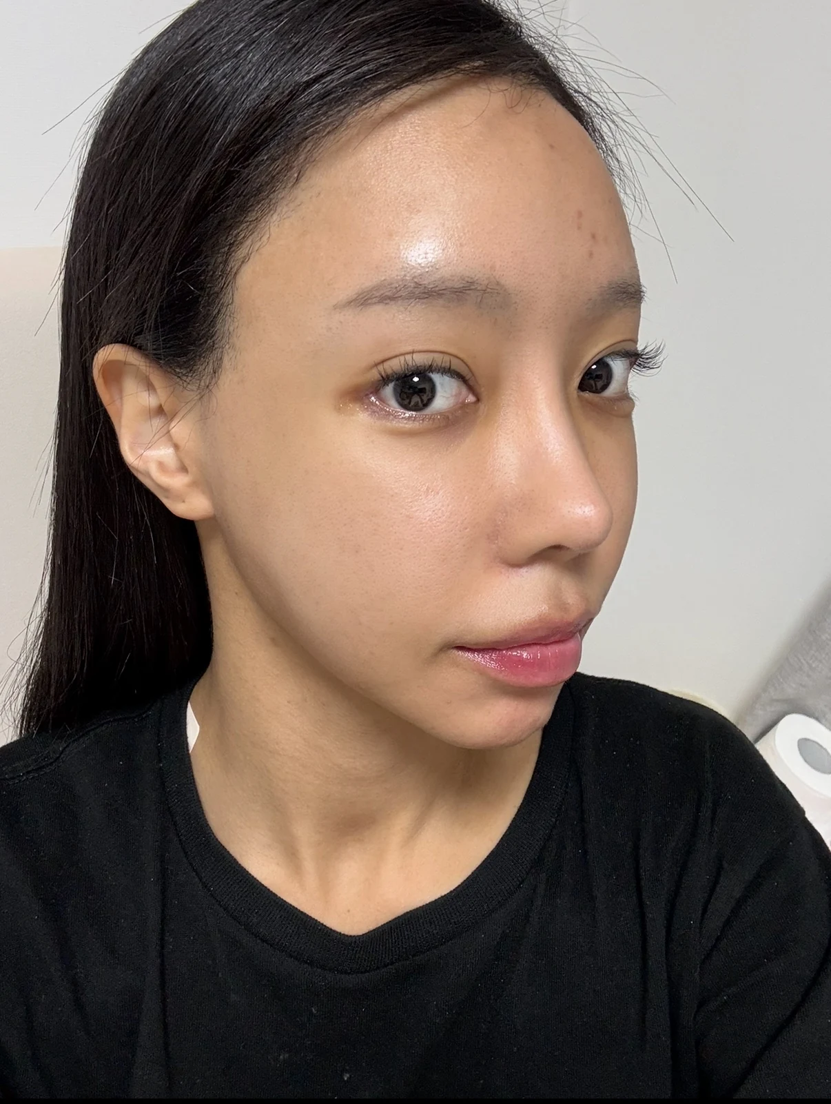 Outer eye-corner revision after previous canthoplasty: six months · Case 088 at Answer Plastic Surgery. Oblique view — 1 week after surgery, outer eye-corner revision after previous canthoplasty at Answer Plastic Surgery (case 088).