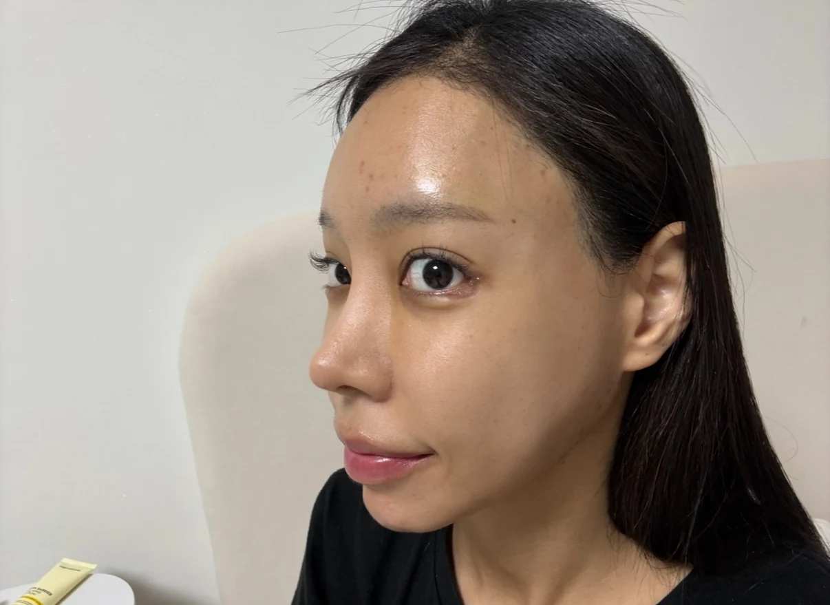 Outer eye-corner revision after previous canthoplasty: six months · Case 088 at Answer Plastic Surgery. Opposite oblique view — 1 week after surgery, outer eye-corner revision after previous canthoplasty at Answer Plastic Surgery (case 088).