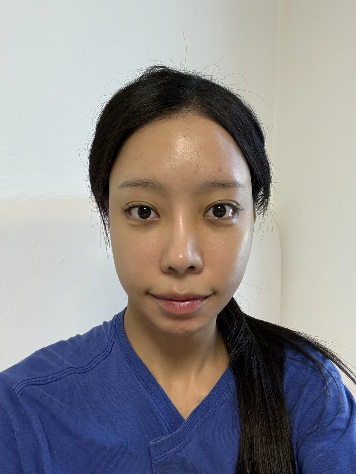 Outer eye-corner revision after previous canthoplasty: six months · Case 088 at Answer Plastic Surgery. Front view — 2 weeks after surgery, outer eye-corner revision after previous canthoplasty at Answer Plastic Surgery (case 088).