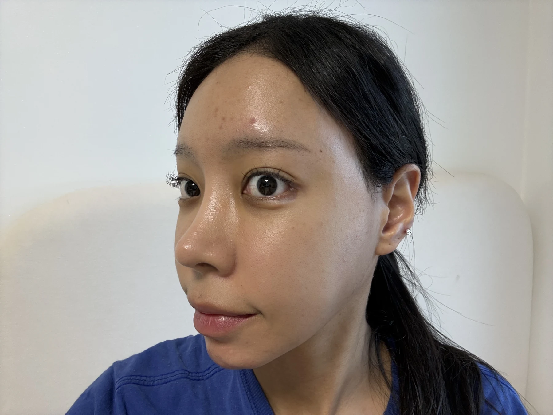Outer eye-corner revision after previous canthoplasty: six months · Case 088 at Answer Plastic Surgery. Oblique view — 2 weeks after surgery, outer eye-corner revision after previous canthoplasty at Answer Plastic Surgery (case 088).