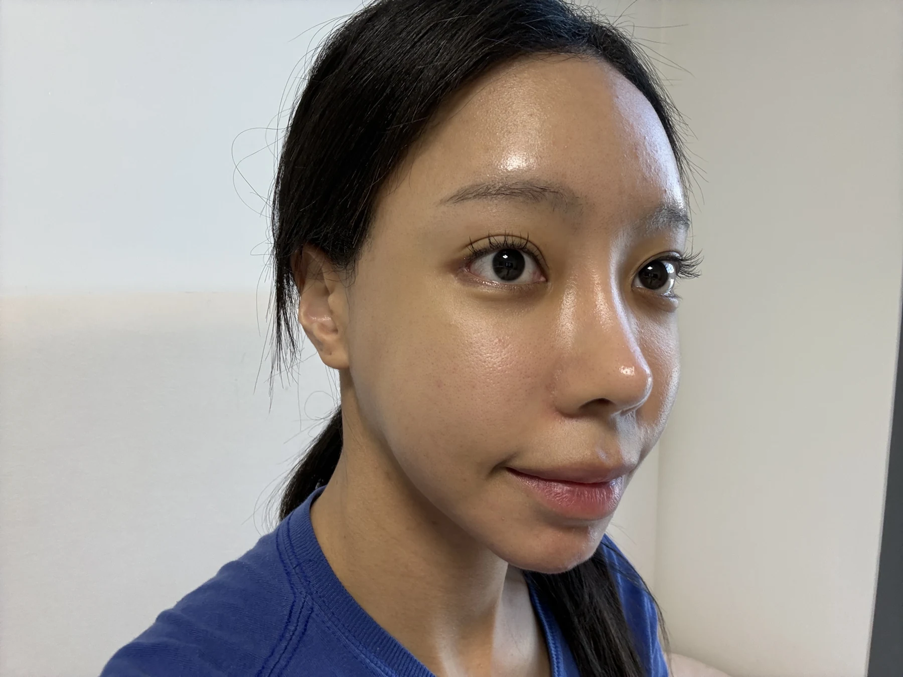 Outer eye-corner revision after previous canthoplasty: six months · Case 088 at Answer Plastic Surgery. Opposite oblique view — 2 weeks after surgery, outer eye-corner revision after previous canthoplasty at Answer Plastic Surgery (case 088).