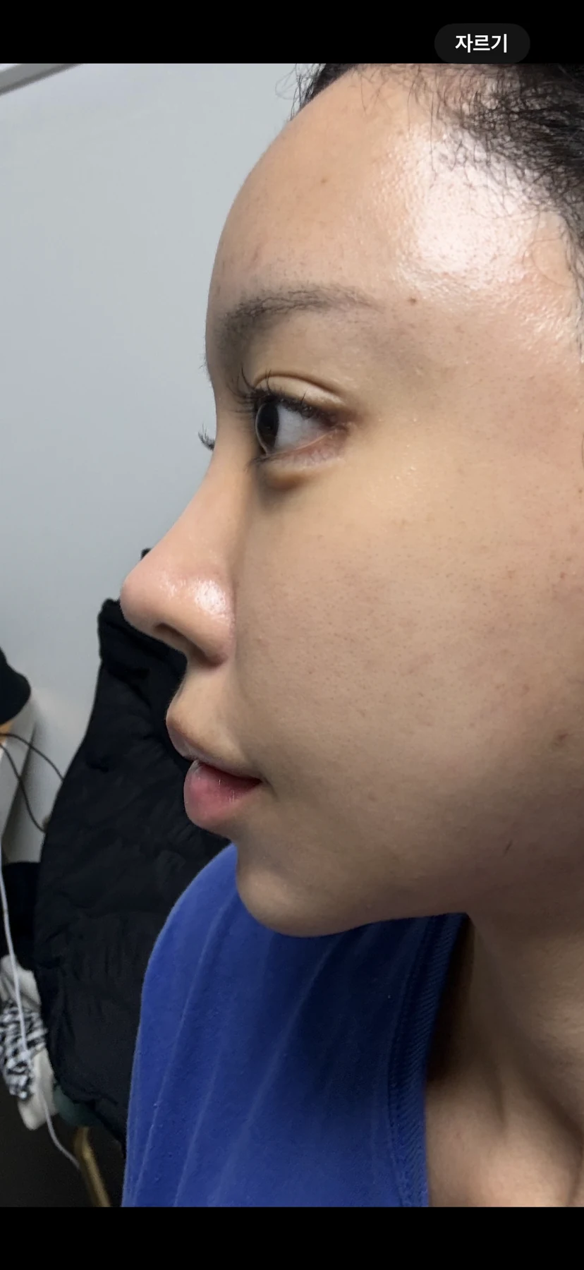 Outer eye-corner revision after previous canthoplasty: six months · Case 088 at Answer Plastic Surgery. Side view — 1 month after surgery, outer eye-corner revision after previous canthoplasty at Answer Plastic Surgery (case 088).