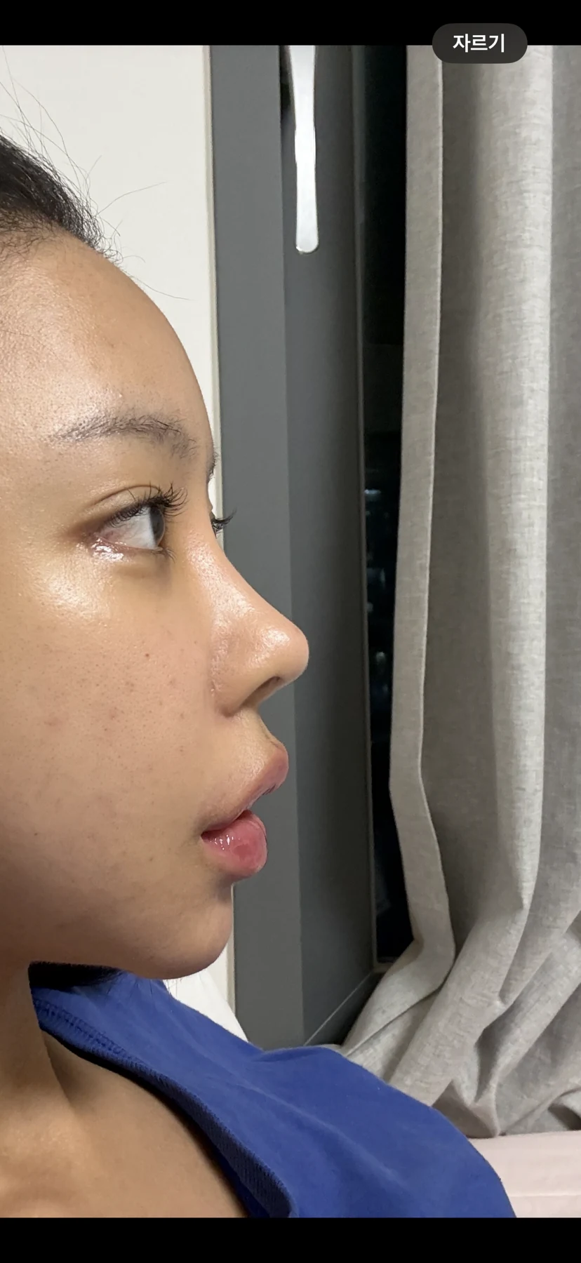 Outer eye-corner revision after previous canthoplasty: six months · Case 088 at Answer Plastic Surgery. Opposite side view — 1 month after surgery, outer eye-corner revision after previous canthoplasty at Answer Plastic Surgery (case 088).