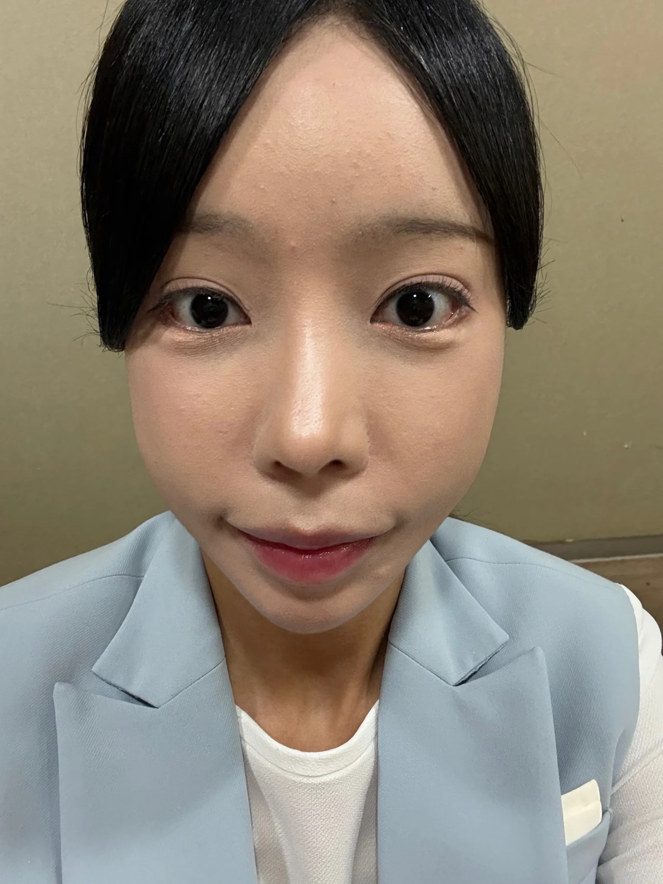 Outer eye-corner revision after previous canthoplasty: six months · Case 088 at Answer Plastic Surgery. Front view — 2 months after surgery, outer eye-corner revision after previous canthoplasty at Answer Plastic Surgery (case 088).