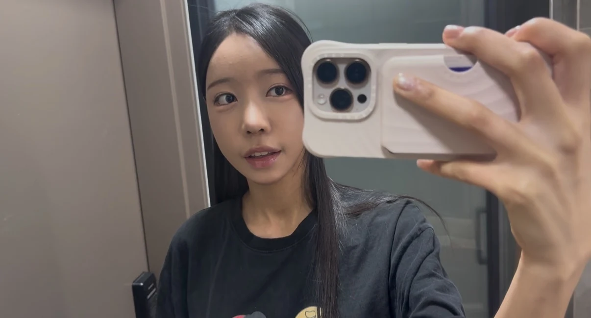 Outer eye-corner revision after previous canthoplasty: six months · Case 088 at Answer Plastic Surgery. Front mirror portrait — 3 months after surgery, outer eye-corner revision after previous canthoplasty at Answer Plastic Surgery (case 088).