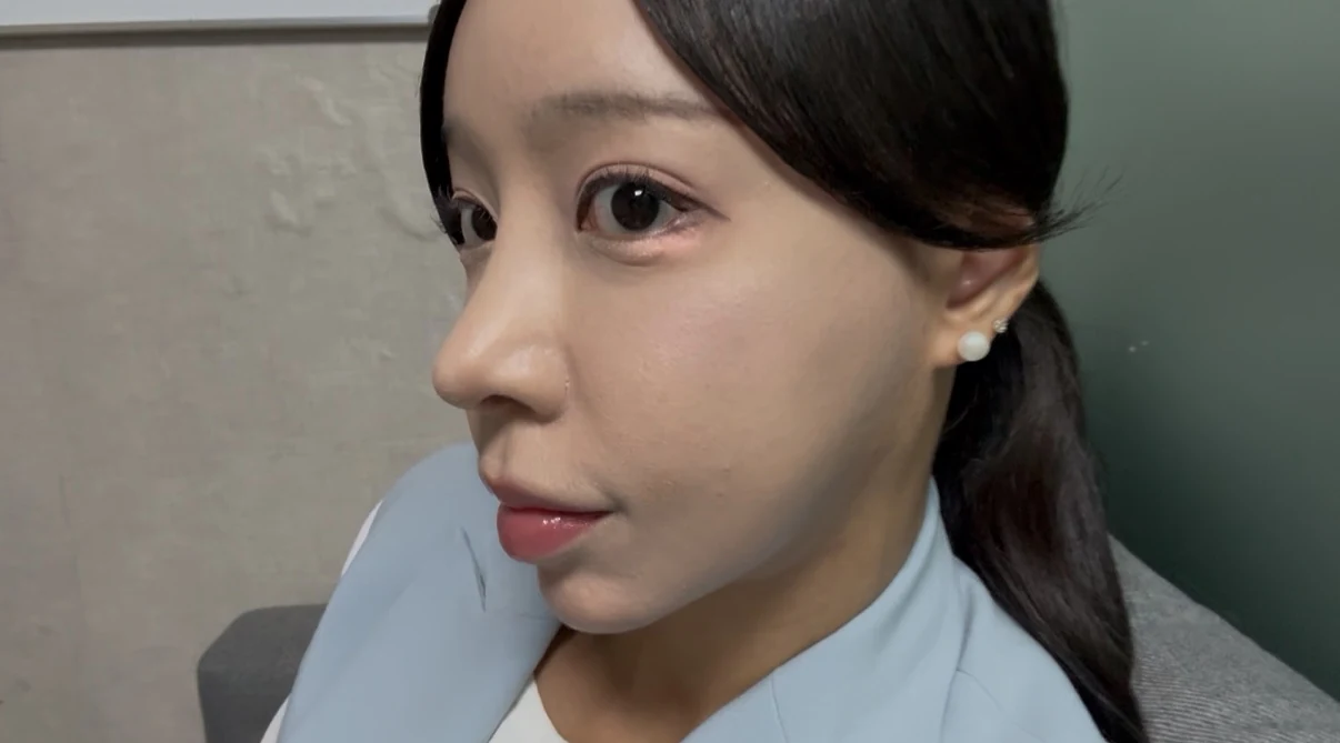 Outer eye-corner revision after previous canthoplasty: six months · Case 088 at Answer Plastic Surgery. Oblique view — 3 months after surgery, outer eye-corner revision after previous canthoplasty at Answer Plastic Surgery (case 088).