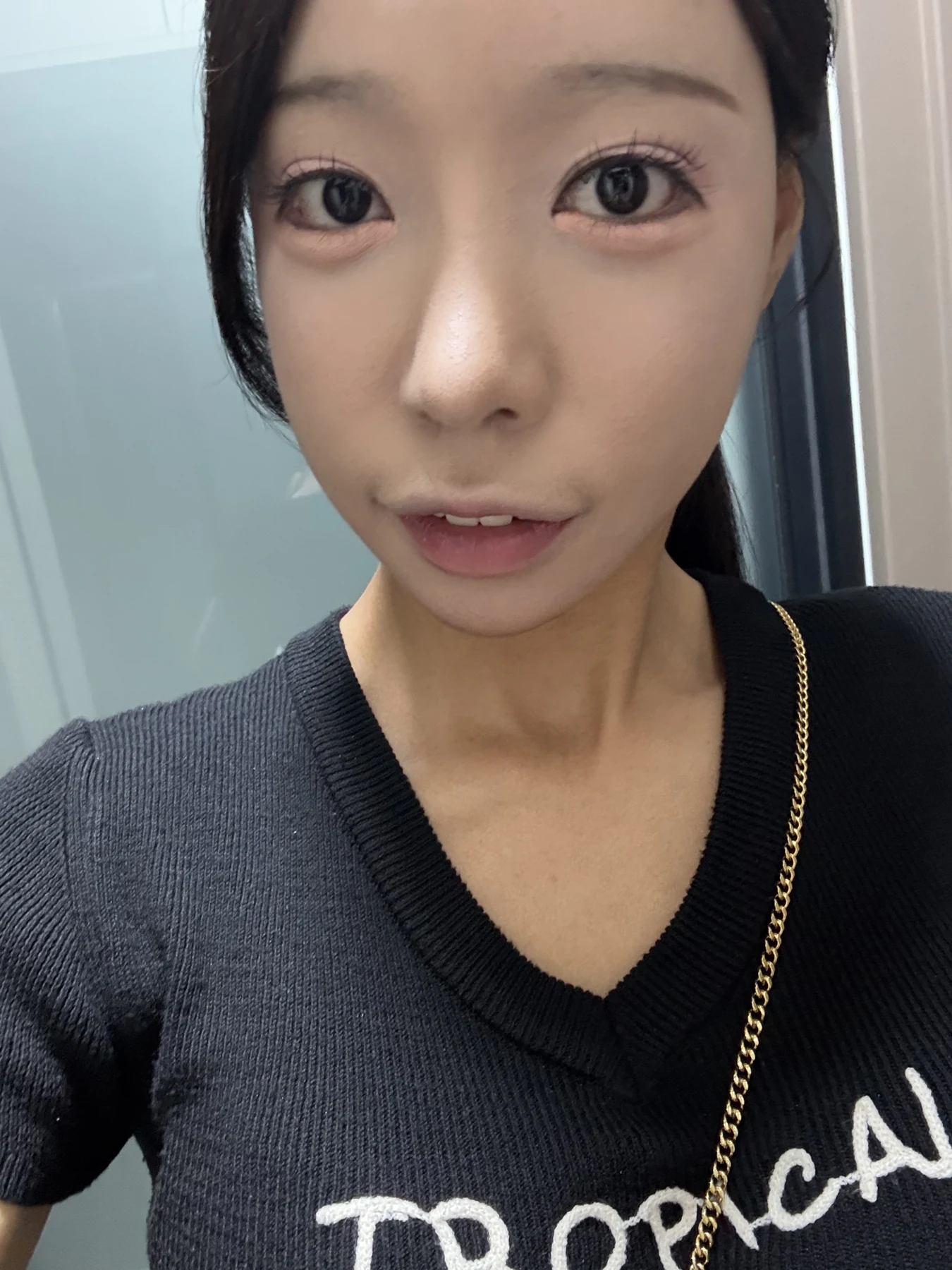 Outer eye-corner revision after previous canthoplasty: six months · Case 088 at Answer Plastic Surgery. Front view — 6 months after surgery, outer eye-corner revision after previous canthoplasty at Answer Plastic Surgery (case 088).