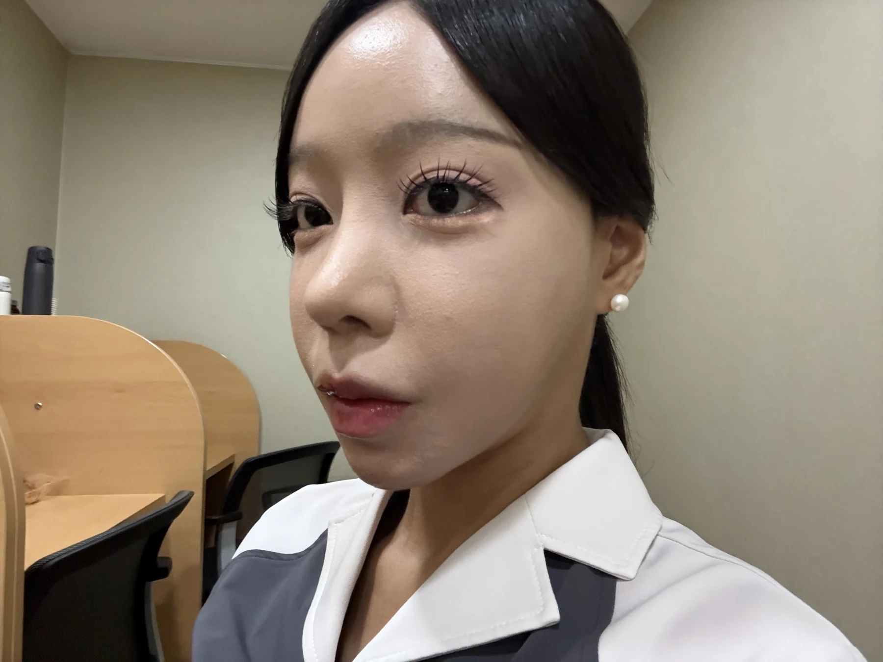 Outer eye-corner revision after previous canthoplasty: six months · Case 088 at Answer Plastic Surgery. Oblique view — 6 months after surgery, outer eye-corner revision after previous canthoplasty at Answer Plastic Surgery (case 088).