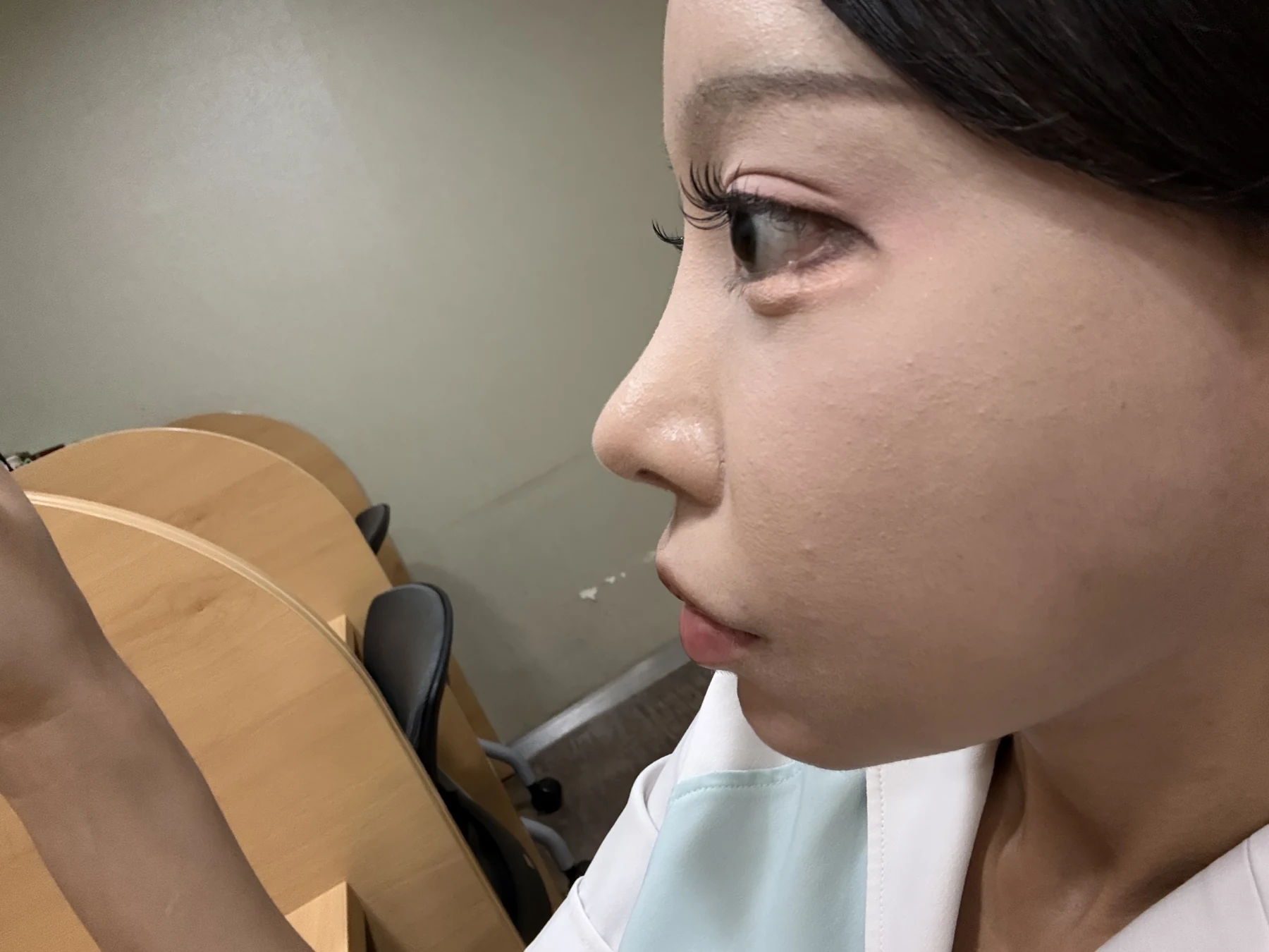 Outer eye-corner revision after previous canthoplasty: six months · Case 088 at Answer Plastic Surgery. Side view — 6 months after surgery, outer eye-corner revision after previous canthoplasty at Answer Plastic Surgery (case 088).