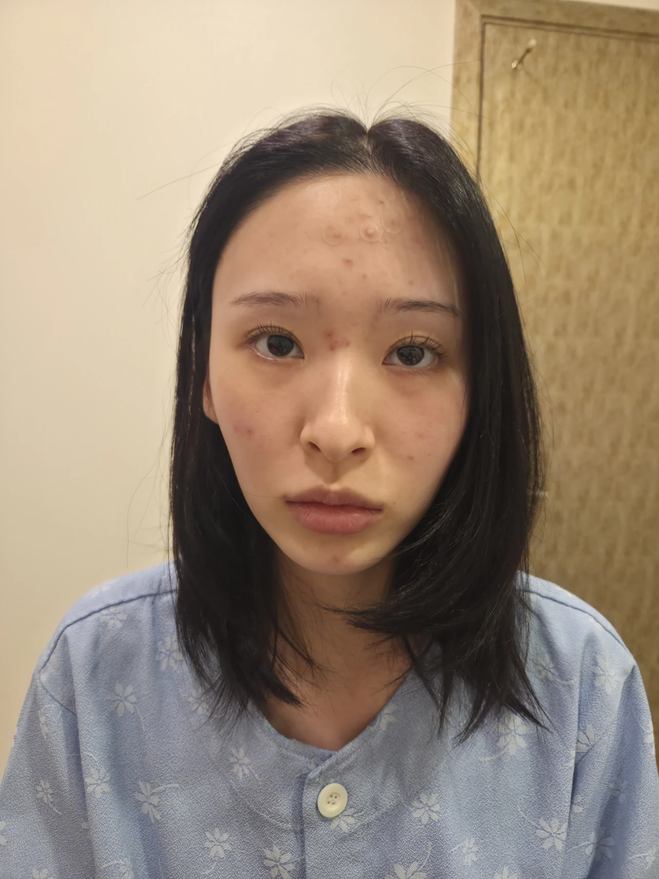 Eye-corner surgery: six-month recovery and smiling concerns · Case 089 at Answer Plastic Surgery. Front view — before, eye-corner surgery at Answer Plastic Surgery (case 089).