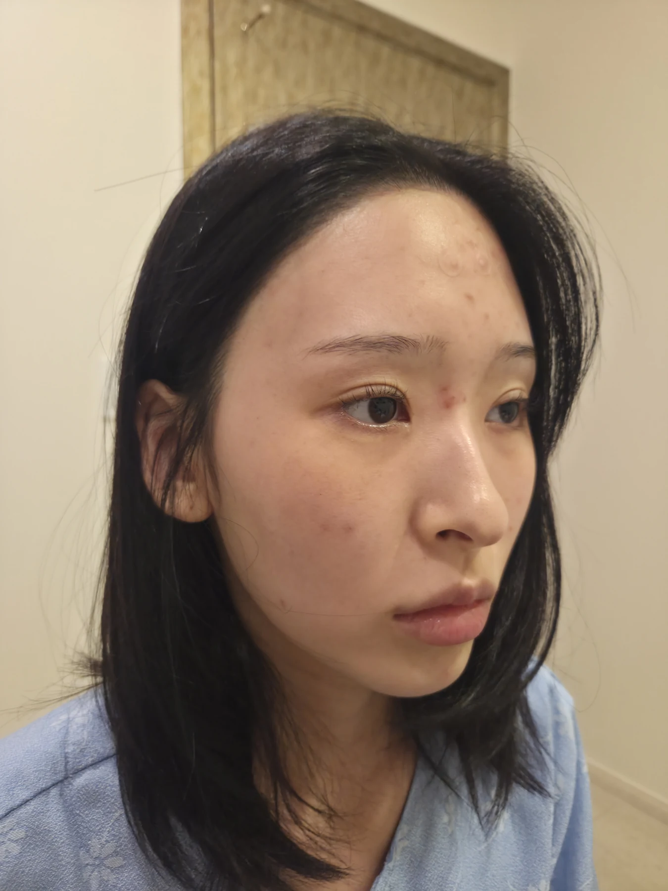 Eye-corner surgery: six-month recovery and smiling concerns · Case 089 at Answer Plastic Surgery. Oblique view — before, eye-corner surgery at Answer Plastic Surgery (case 089).
