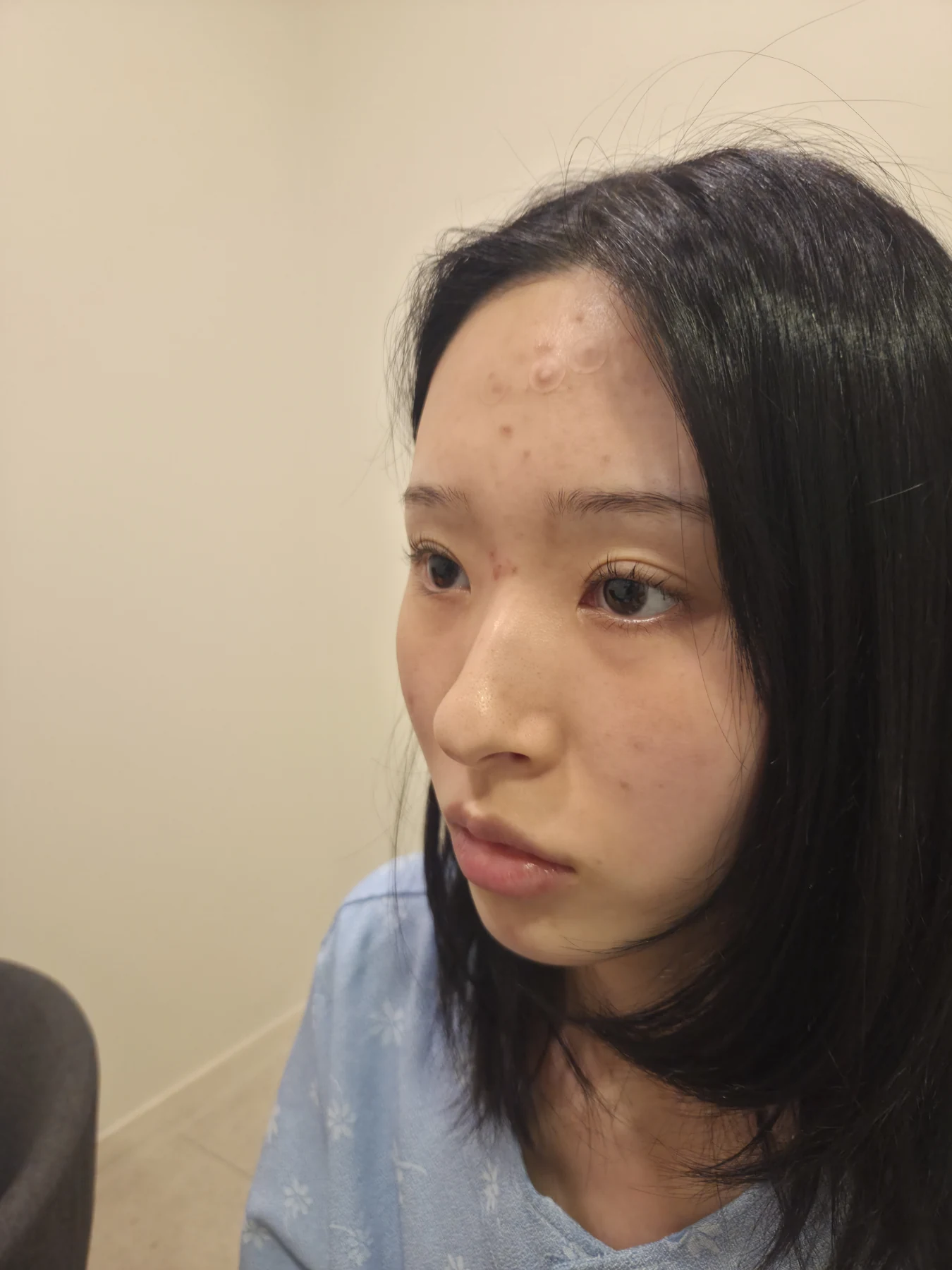 Eye-corner surgery: six-month recovery and smiling concerns · Case 089 at Answer Plastic Surgery. Opposite oblique view — before, eye-corner surgery at Answer Plastic Surgery (case 089).