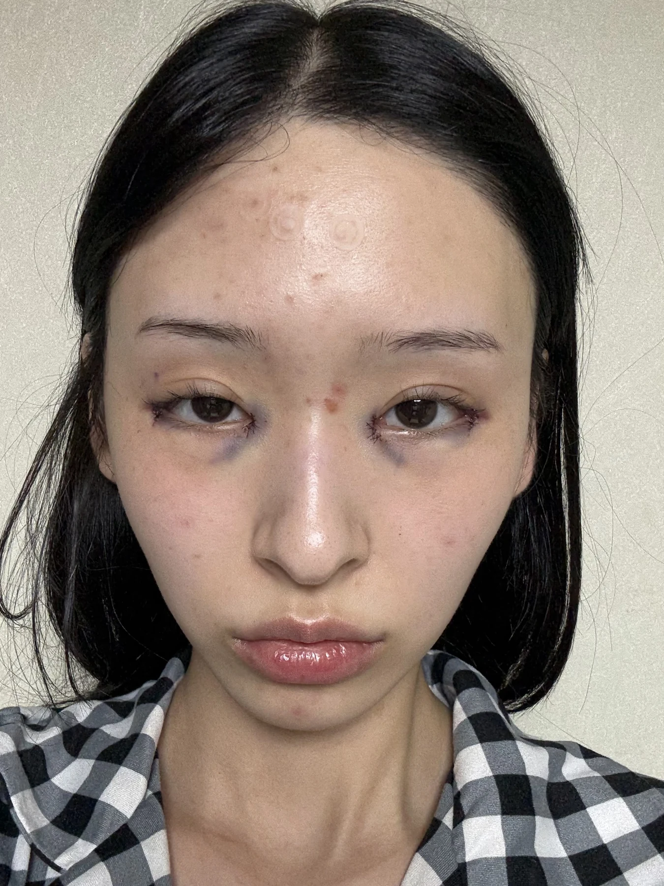 Eye-corner surgery: six-month recovery and smiling concerns · Case 089 at Answer Plastic Surgery. Front view — surgery day, eye-corner surgery at Answer Plastic Surgery (case 089).