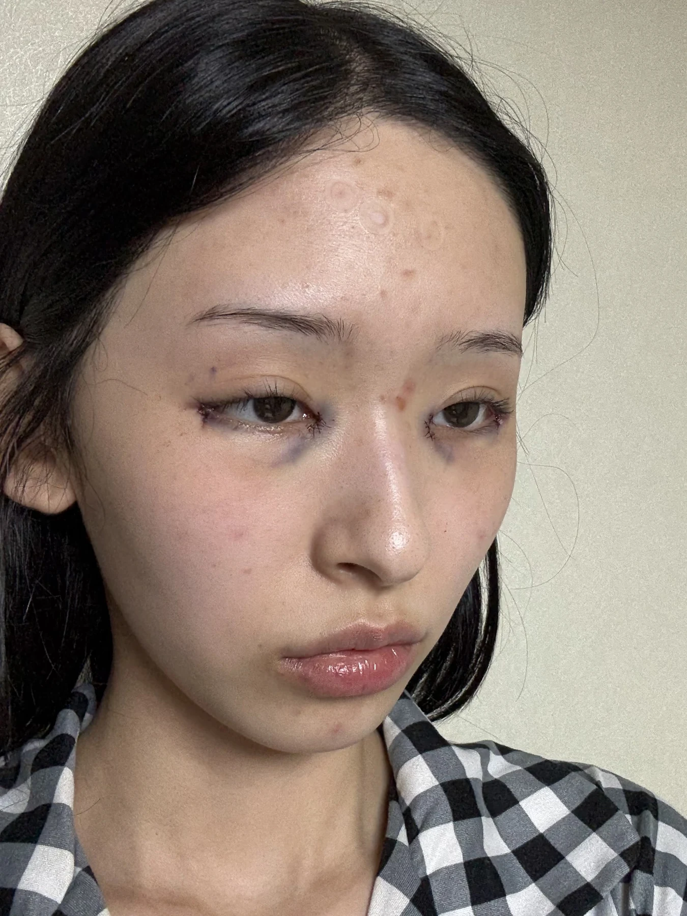 Eye-corner surgery: six-month recovery and smiling concerns · Case 089 at Answer Plastic Surgery. Oblique view — surgery day, eye-corner surgery at Answer Plastic Surgery (case 089).