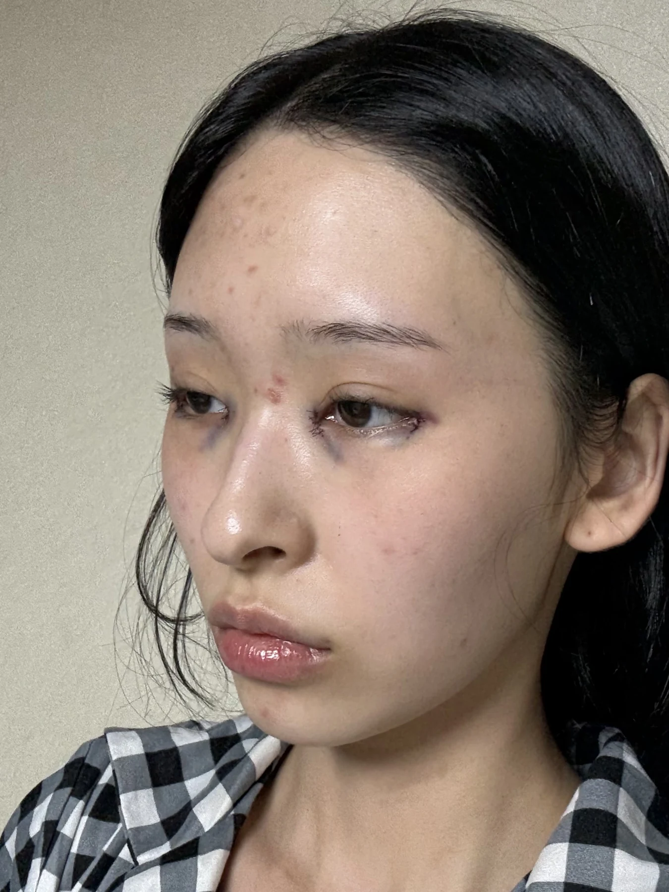 Eye-corner surgery: six-month recovery and smiling concerns · Case 089 at Answer Plastic Surgery. Opposite oblique view — surgery day, eye-corner surgery at Answer Plastic Surgery (case 089).