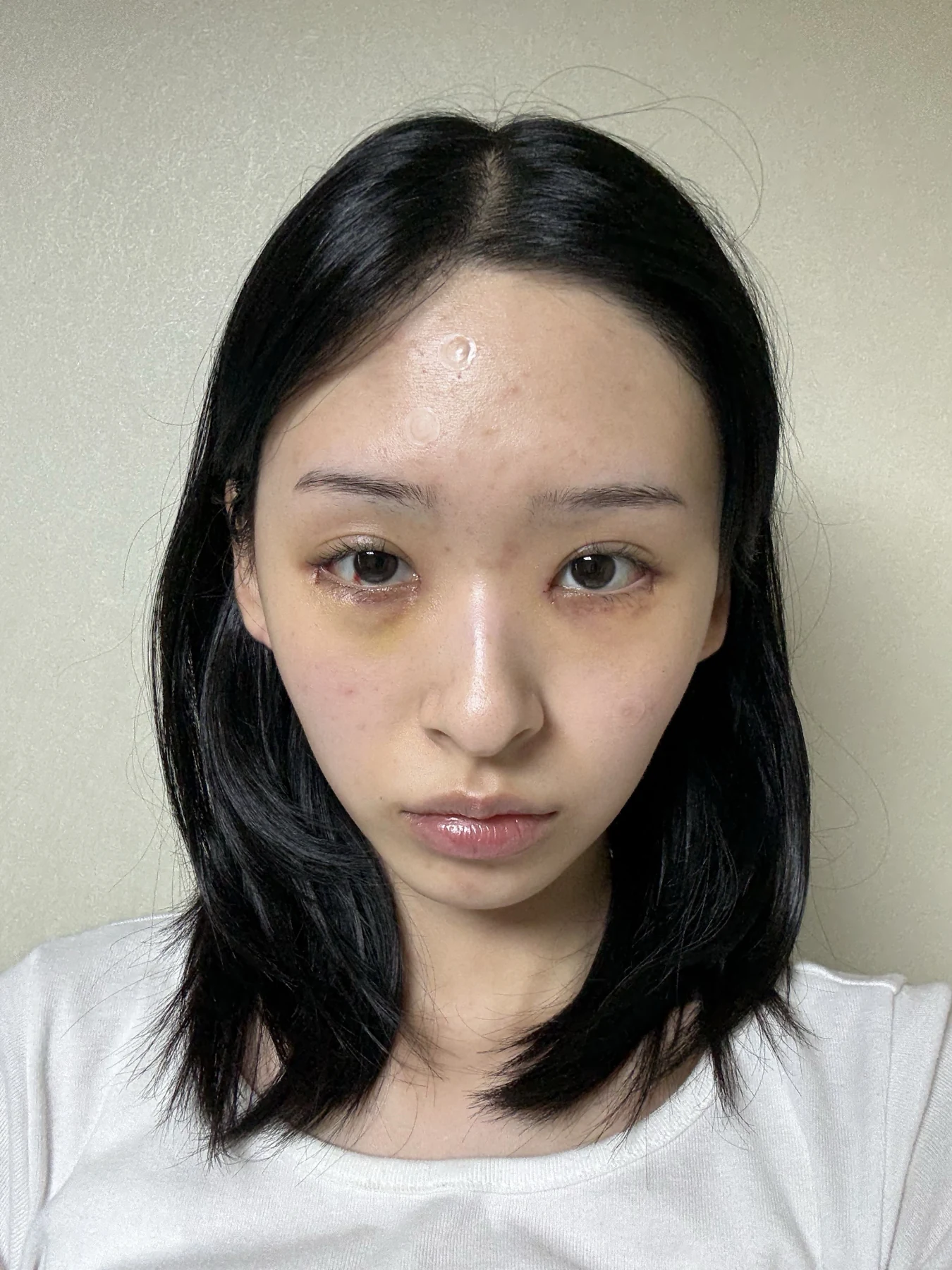 Eye-corner surgery: six-month recovery and smiling concerns · Case 089 at Answer Plastic Surgery. Front view — 1 week after surgery, eye-corner surgery at Answer Plastic Surgery (case 089).