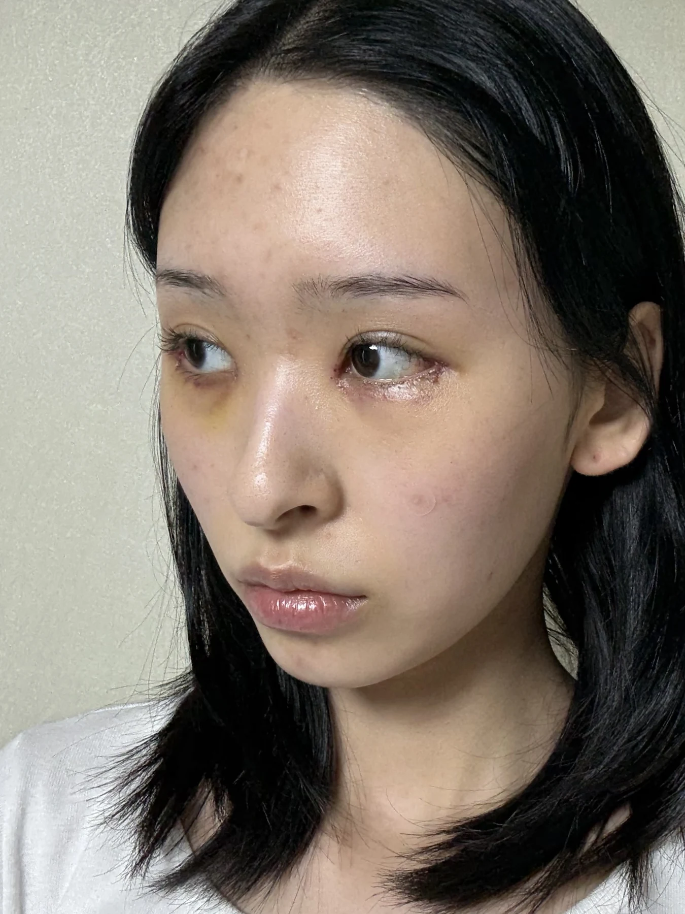 Eye-corner surgery: six-month recovery and smiling concerns · Case 089 at Answer Plastic Surgery. Oblique view — 1 week after surgery, eye-corner surgery at Answer Plastic Surgery (case 089).