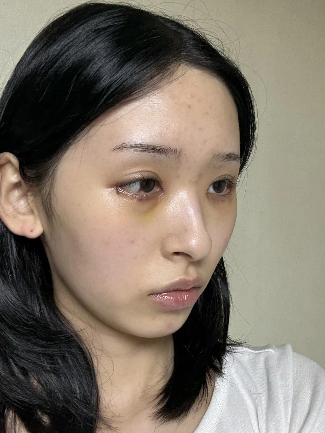 Eye-corner surgery: six-month recovery and smiling concerns · Case 089 at Answer Plastic Surgery. Opposite oblique view — 1 week after surgery, eye-corner surgery at Answer Plastic Surgery (case 089).