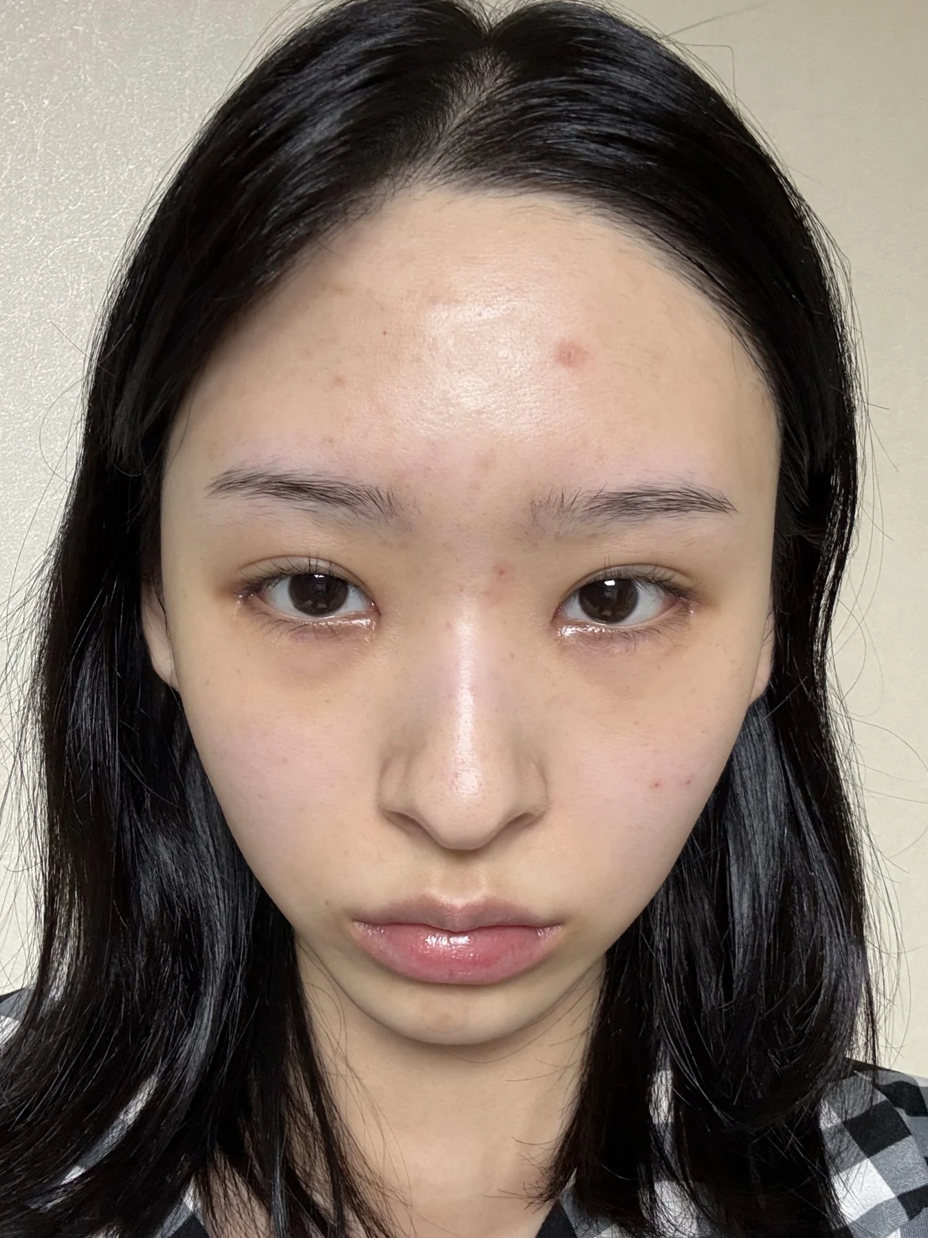 Eye-corner surgery: six-month recovery and smiling concerns · Case 089 at Answer Plastic Surgery. Front view — 2 weeks after surgery, eye-corner surgery at Answer Plastic Surgery (case 089).