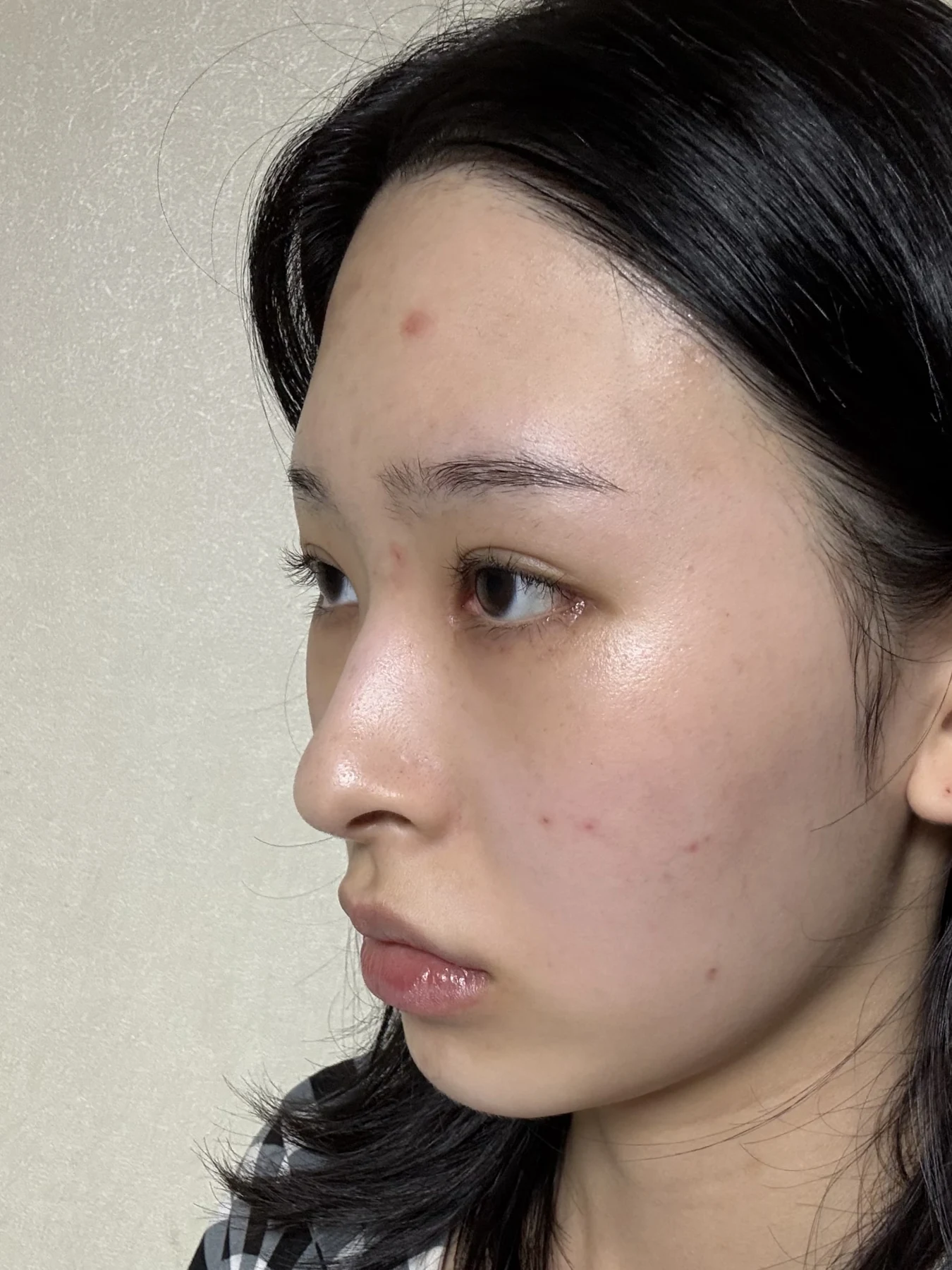 Eye-corner surgery: six-month recovery and smiling concerns · Case 089 at Answer Plastic Surgery. Oblique view — 2 weeks after surgery, eye-corner surgery at Answer Plastic Surgery (case 089).